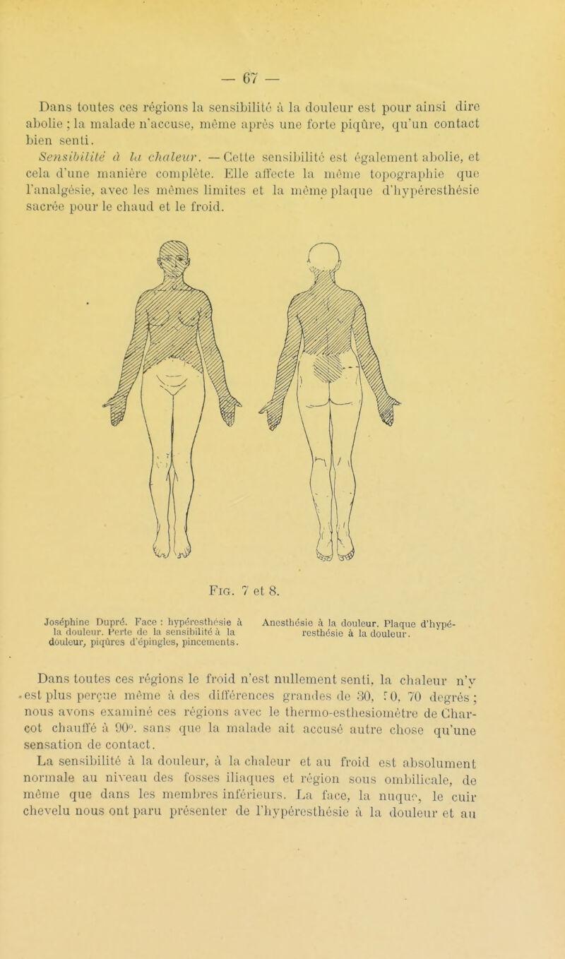 Dans toutes ces régions la sensibilité ù la douleur est pour ainsi dire abolie ; la malade n'accuse, même après une forte piqûre, qu'un contact bien senti. Sensibilité à la chaleur. —Cette sensibilité est également abolie, et cela d'une manière complète. Elle affecte la môme topographie que l'analgésie, avec les mêmes limites et la même plaque d'hypéresthésie sacrée pour le chaud et le froid. FiG. 7 et 8. Joséphine Dupré. Face : hypéresthosie à Anesthésie à la douleur. Plaque d'hypé- la douleur. Porte de la sensibilité à la rcsthésie à la douleur, doideur, piqûres d'épingles, pincements. Dans toutes ces régions le froid n'est nullement senti, la clialeur n'v -est plus perçue même à des dilïérences grandes de 30, T 0, 70 degrés; nous avons examiné ces régions avec le thermo-esthesiométre de Char- cot chauffé à 90^. sans que la malade ait accusé autre chose qu'une sensation de contact. La sensibilité à la douleur, ù la chaleur et au froid est absolument normale au niveau des fosses iliaques et région sous ombilicale, do même que dans les membres inférieurs. La face, la nuque, le cuir chevelu nous ont paru présenter de l'hypéresthésie à la douleur et au