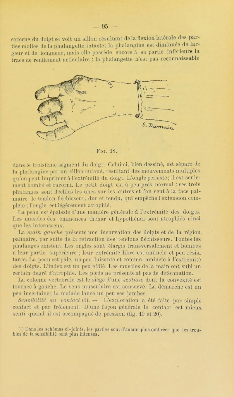 externe du doigt se voit un sillon résultant de la flexion latérale des par- ties molles de la phalangette intacte; la phalangine est diminuée de lar- geur et de longueur, mais elle possède encore à sa partie inférieure la trace de renflement articulaire : la phalangette n'est pas reconnaissablc FiG. 18. dans le troisième segment du doigt. Celui-ci, Lien dessiné, est séparé de la phalangine par un sillon cutané, résultant des mouvements multiples qu'on peut imprimer à l'extrémité du doigt. L'ongle persiste; il est seule- ment bombé et racorni. Le petit doigt est à peu près normal : ses trois phalanges sont fléchies les unes sur les autres et l'on sent à la face pal- maire le tendon fléchisseur, dur et tendu, qui empêche l'extension com- plète ; l'ongle est légèrement atrophié. La peau est épaissie d'une manière générale à l'extrémité des doigts. Les muscles des éminences thénar et hypothénar sont atrophiés ainsi que les interosseux. La main gauche présente une incurvation des doigts et de la région palmaire, par suite de la rétraction des tendons fléchisseurs. Toutes les phalanges existent. Les ongles sont élargis transversalement et bombés à leur partie supérieure : leur extrémité libre est amincie et peu résis- tante. La peau est pâle, un peu luisante et comme amincie à l'extrémité des doigts. L'index est un peu effilé. Les muscles delà main ont subi un certain degré d'atrophie. Les pieds ne présentent pas de déformation. La colonne vertébrale est le siège d'une scoliose dont la convexité est tournée à gauche. Le sens musculaire est conservé. La démarche est un peu incertaine; lu malade lance un peu ses jambes. Sensibilité au contact (1). — L'exploration a été faite par simple contact et par frôlement. D'une façon générale le contact est mieux senti quand il est accompagné de pression (flg. 19 et 20). (1) Dans les schémas ci-joinls, les parties sont d'autant plus ombrées que les trou- bles de la sensibilité sont plus intenses.