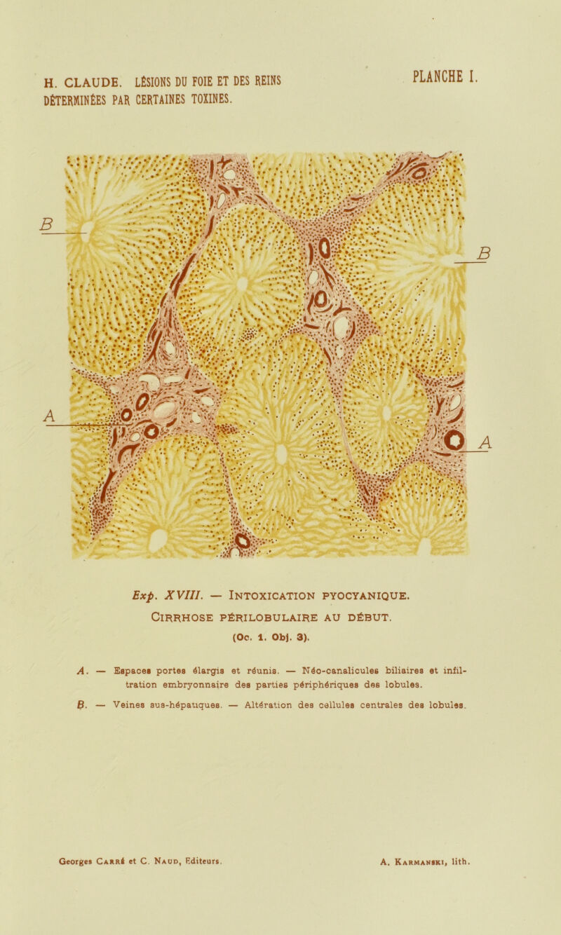 H. CLAUDE. LÉSIONS DU FOIE ET DES REINS PLANCHE I. DÉTERMINÉES PAR CERTAINES TOXINES. Exp. XVIII. — Intoxication pyocyanique. Cirrhose périlobulaire au début. (Oc. 1. ObJ. 3). A. — Espaces portes élargis et réunis. — Néo-canaliculee biliaires et infil- tration embryonnaire des parties périphériques des lobules. B. — Veines sus-hépatiques. — Altération des cellules centrales des lobules.