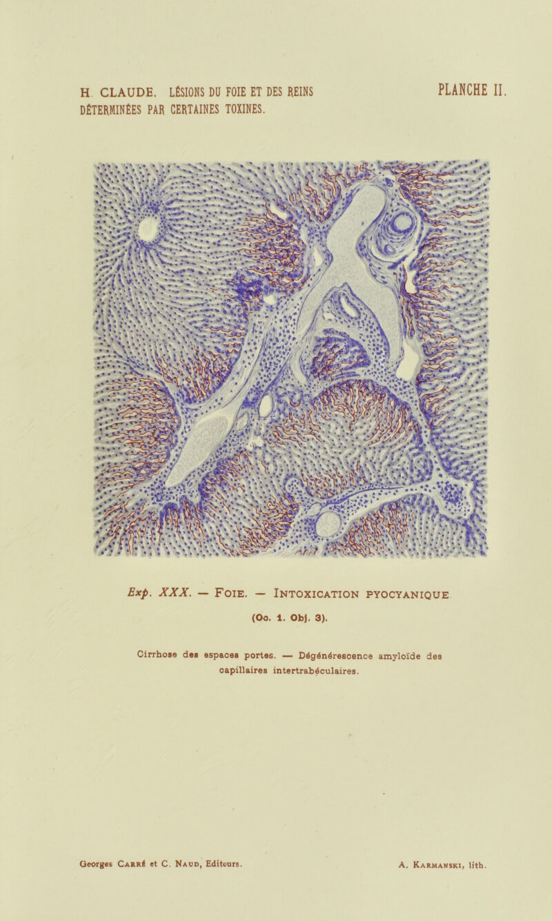 DETERMINEES PAR CERTAINES TOXINES. Exp. XXX. — Foie. — Intoxication pyocyanique (Oo. 1. ObJ. 3). Cirrhose des espaces portes. — Dégénérescence amyloïde des capillaires intertrabéculaires.