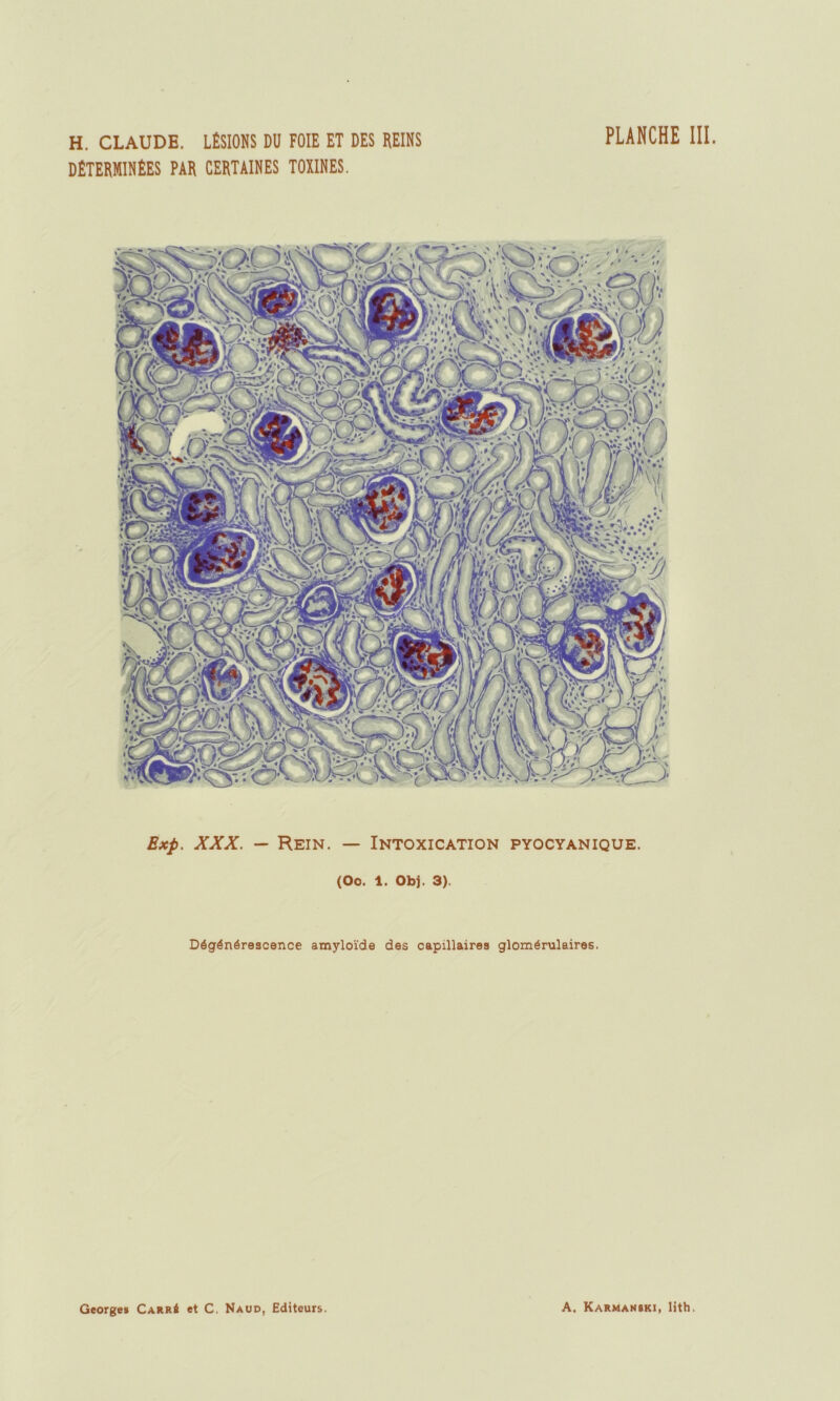 DÉTERMINÉES PAR CERTAINES TOXINES. PLANCHE III. Exp. XXX. — Rein. — Intoxication pyocyanique. (Oo. 1. Obj. 3). Dégénérescence amyloïde des capillaires glomérulaires.