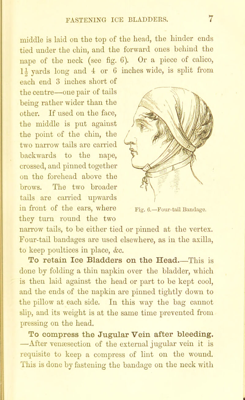 middle is laid on the top of the head, the hinder ends tied imder the chin, and the forward ones behind the nape of the neck (see fig. G). Or a piece of calico, H yards long and 4 or G inches wide, is split from each end 3 inches short of the centre—one pair of tails being rather wider than the other. If used on the face, the middle is put against the point of the chin, the two narrow tails are carried backwards to the nape, crossed, and pinned together on the foreliead above the brows. The two bi'oader tails are canied upwards in front of the ears, where they tm'n round the two naiTow tails, to be either tied or pinned at the vertex. Four-tail bandages are used elsewhere, as in the axilla, to keep poultices in place, (fee. To retain Ice Bladders on the Head This is done by folding a thin napkin over the bladder, which is then laid against the head or part to be kept cool, and the ends of the napkin are pinned tightly down to the pillow at each side. In this way the bag cannot slip, and its weight is at the same time prevented from pressing on the head. To compress the Jugular Vein after bleeding. —After ventesection of the external jugular vein it is requisite to keep a compress of lint on the wound. This is done by fastening the bandage on the neck with Fig. 6.—Four-tail Bandage.