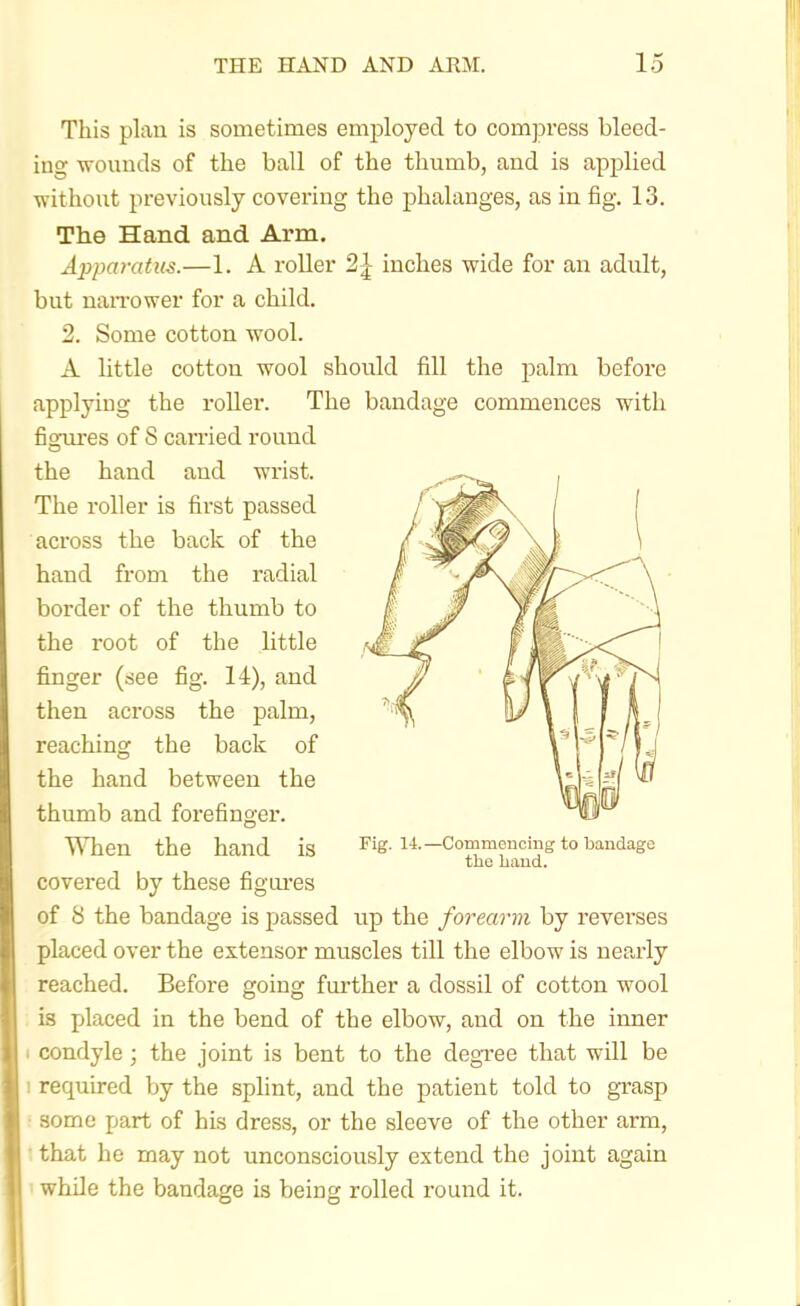 This plan is sometimes employed to compress bleed- iug wouuds of the ball of the thumb, and is applied without previously covering the phalanges, as in fig. 13. The Hand and Arm. Apparatus.—1. A roller 2| inches wide for an adult, but naiTower for a child. 2. Some cotton wool. A little cotton wool should fill the palm before applying the roller. The bandage commences with fioures of S can-ied round the hand and wrist. The I'oller is first passed across the back of the hand from the radial border of the thumb to the root of the little finger (see fig. 14), and then across the palm, reaching the back of the hand between the thumb and forefinger. UTien the hand is Fig. li.-Commencing to bandage the baud. covered by these figm-es of 8 the bandage is passed up the forearm by reverses placed over the extensor muscles till the elbow is nearly reached. Before going fm'ther a dossil of cotton wool ; is placed in the bend of the elbow, and on the inner I condyle; the joint is bent to the degi-ee that will be 1 required by the splint, and the patient told to grasp • some part of his dress, or the sleeve of the other arm, that he may not unconsciously extend the joint again 1 while the bandage is being rolled round it. 1