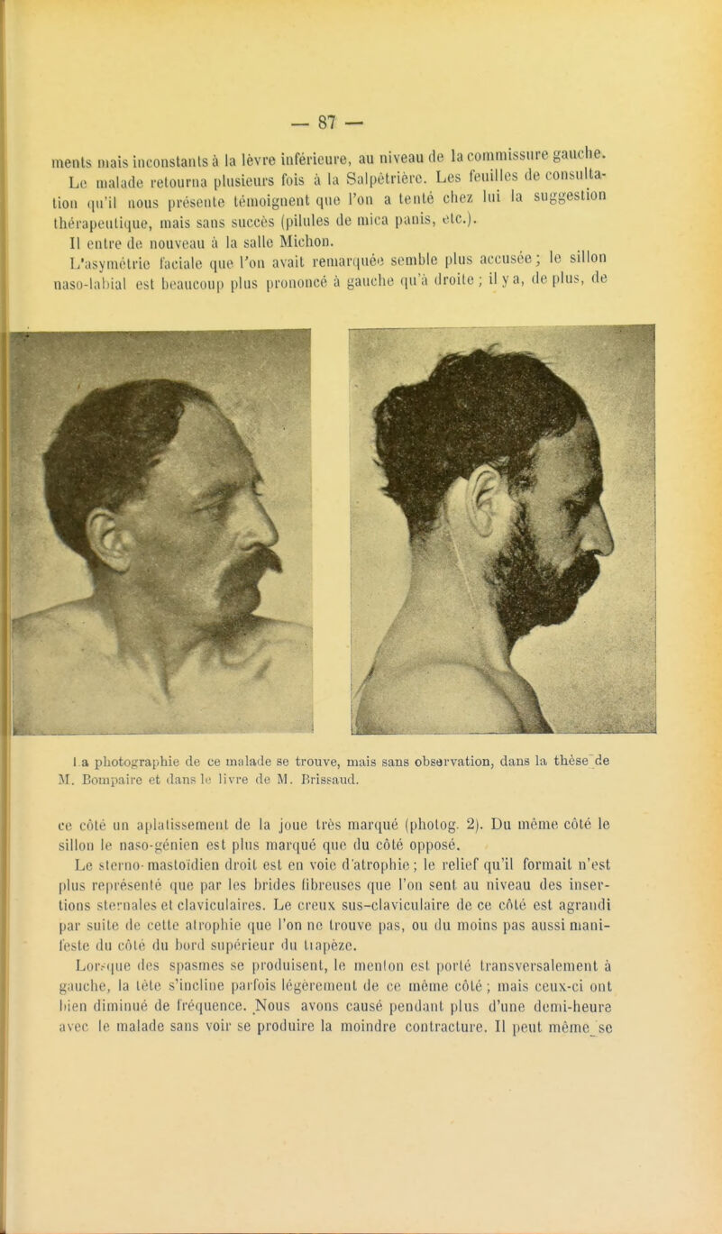 ments mais inconstants à la lèvre inférieure, au niveau de la commissiire gauche. Le malade retourna plusieurs fois à la Salpètrière. Les feuilles de consulta- tion (lu'il nous présente témoignent que l'on a tenté chez lui la suggestion thérapeutique, mais sans succès (pilules de mica panis, etc.). Il entre de nouveau à la salle Michon. L'asymétrie faciale que Ton avait remarquée semble plus accusée; le sillon naso-labial est beaucoup plus prononcé à gauche qu'à droite ; il y a, de plus, de l a photograi>hie de ce malade se trouve, mais sans observation, dans la thèse de M. Bompaire et dans li' livre de M. Brissaud. ce côté un aplatissement de la joue très marqué (pholog. 2). Du même côté le sillon le naso-génien est plus marqué que du côté opposé. Le stcrno-mastoïdien droit est en voie d'atrophie; le relief qu'il formait n'est plus représenté que par les brides fibreuses que l'on sent au niveau des inser- tions sternales et claviculaires. Le creux sus-claviculaire de ce côté est agrandi par suite de cette atrophie ([ue l'on ne trouve pas, ou du moins pas aussi mani- feste du côté du bord supérieur du tiapèze. Lor,-(|ue des spasmes se produisent, le menlon est porté transversalement à gauche, la tète s'incline parfois légèrement de ce même côté ; mais ceux-ci ont bien diminué de fréquence. Nous avons causé pendant plus d'une demi-heure avec le malade sans voir se produire la moindre contracture. Il jjeut même se