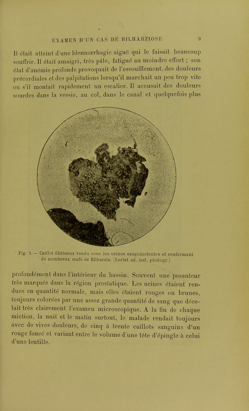 V EXAMEN D'UN CAS DE BILHARZIOSE 9 11 était atteint d'une blennorrhagic aiguë qui le faisait beaucoup souffrir. Il était amaigri, très pâle, fatigué au moindre effort ; son état d'anémie profonde provoquait de l'essoufflement, des douleurs précordiales et des palpitations lorsqu'il marchait un peu trop vite ou s'il montait rapidement un escalier. Il accusait des douleurs sourdes dans la vessie, au col, dans le canal et quelquefois plus Fig. L— Caillol fibrineux rendu avec les urines sanguinolentes et renfermant de nombreux œufs de Bilharzia. (Lortet ad. nat. photogr.) profondément dans l'intérieur du bassin. Souvent une pesanteur très marquée dans la région prostatique. Les urines étaient ren- dues en quantité normale, mais elles étaient rouges ou brunes, toujours colorées par une assez grande quantité de sang que déce- lait très clairement l'examen microscopique. A la fm de chaque miction, la nuit et le malin surtout, le malade rendait toujours avec de vives douleurs, de cinq à trente caillots sanguins d'un rouge foncé et variant entre le volume d'une tête d'épingle à celui d'une lentille.