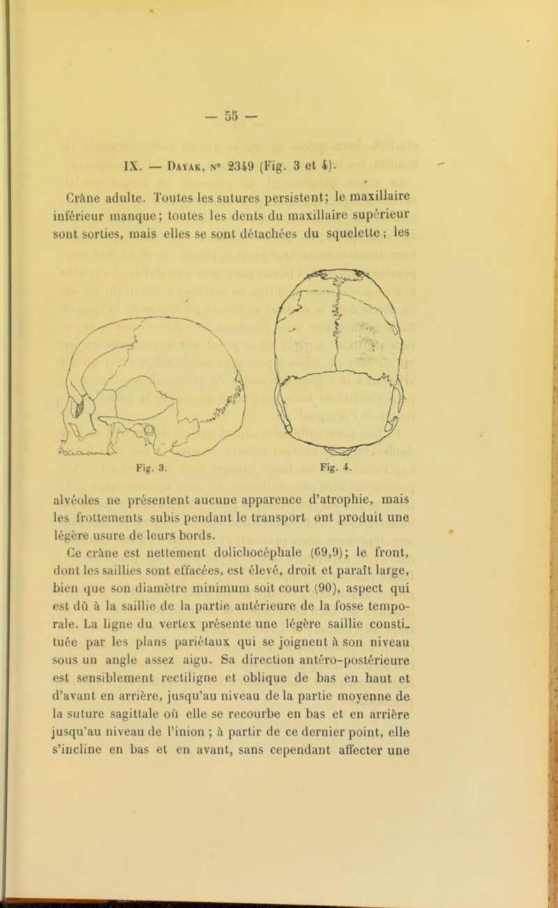 IX. — Dayak, n 2349 (Fig. 3 et 4). 4 Crâne adulte. Toutes les sutures persistent; le maxillaire inférieur manque; toutes les dents du maxillaire supérieur sont sorties, mais elles se sont détachées du squelette ; les alvéoles ne présentent aucune apparence d'atrophie, mais les frottements subis pendant le transport ont produit une légère usure de leurs bords. Ce crâne est nettement dolichocéphale (C9,9) ; le front, dont les saiUies sont effacées, est élevé, droit et paraît large, bien que son diamètre minimum soit court (90), aspect qui est dû h la saillie de la partie antérieure de la fosse tempo- rale. La hgne du verLex présente une légère saillie consti- tuée par les plans pariétaux qui se joignent à son niveau sous un angle assez aigu. Sa direction antéro-postérieure est sensiblement rectiligne et oblique de bas en haut et d'avant en arrière, jusqu'au niveau delà partie moyenne de la suture sagittale où elle se recourbe en bas et en arrière jusqu'au niveau de l'inion ; à partir de ce dernier point, elle s'incline en bas et en avant, sans cependant affecter une