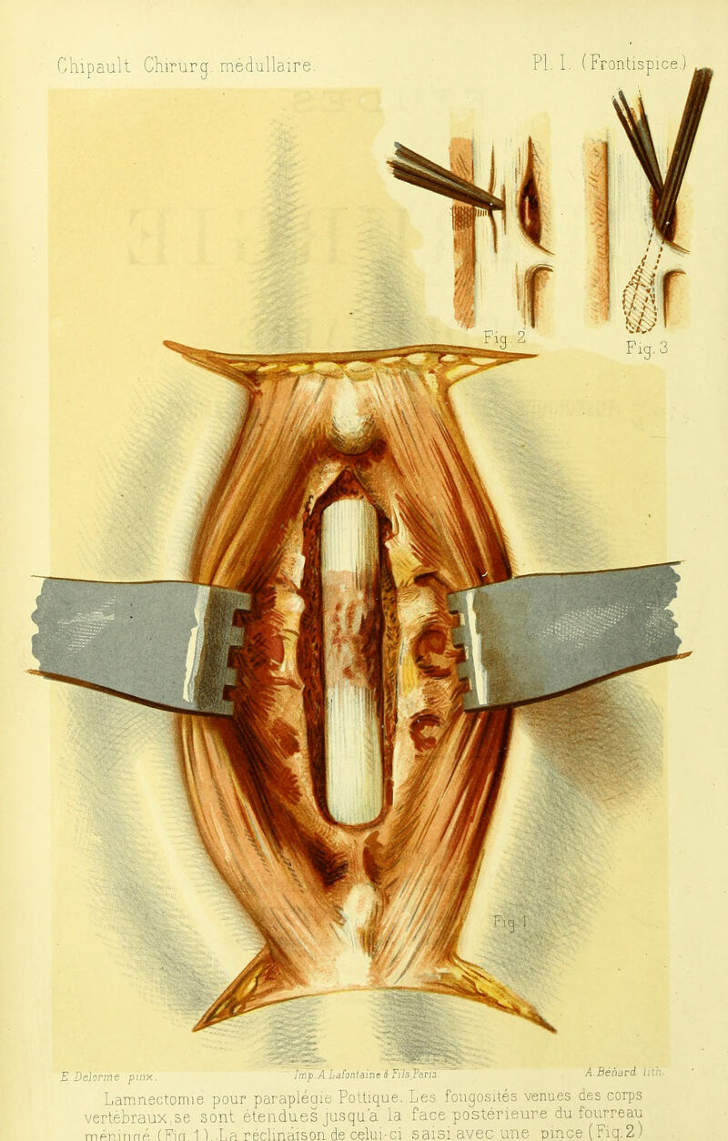 Lamnectomie pour par'apléaie Pottique. Les fougosités venues des corps vertébraux,se sont étendues jusqu'à la face postérieure du fourreau ménuiné (Fia. 1 !..La réclmaison de celui-ci saisi avec une pince (Fiq.2)