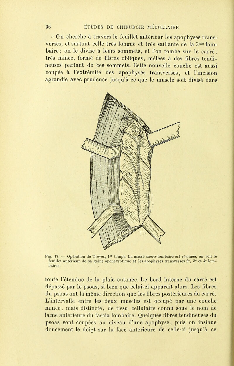 « On cherche à travers Je feuillet antérieur les apophyses Irans- verses, et surtout celle très longue et très saillante de la S™'^ lom- baire; on le divise à leurs sommets, et l'on tombe sur le carré, très mince, formé de fibres obhques, mêlées à des fibres tendi- neuses partant de ces sommets. Cette nouvelle couche est aussi coupée à l'extrémité des apophyses transverses, et l'incision agrandie avec prudence jusqu'à ce que le muscle soit divisé dans Fig. 17. — Opération de Trêves, 1'^' temps. La masse sacro-lombaire est récliaée, on voit le feuillet antérieur de sa gaine aponévrotique et les apophyses transverses 2°, 3° et 4 lom- baires. toute l'étendue de la plaie cutanée. Le bord interne du carré est dépassé par le psoas, si bien que celui-ci apparaît alors. Les fibres du psoas ont la même direction que les fibres postérieures du carré. L'intervalle entre les deux muscles est occupé par une couche mince, mais distincte, de tissu cellulaire connu sous le nom de lame antérieure du fascia lombaire. Quelques fibres tendineuses du psoas sont coupées au niveau d'une apophyse, puis on insinue doucement le doigt sur la face antérieure de celle-ci jusqu'à ce