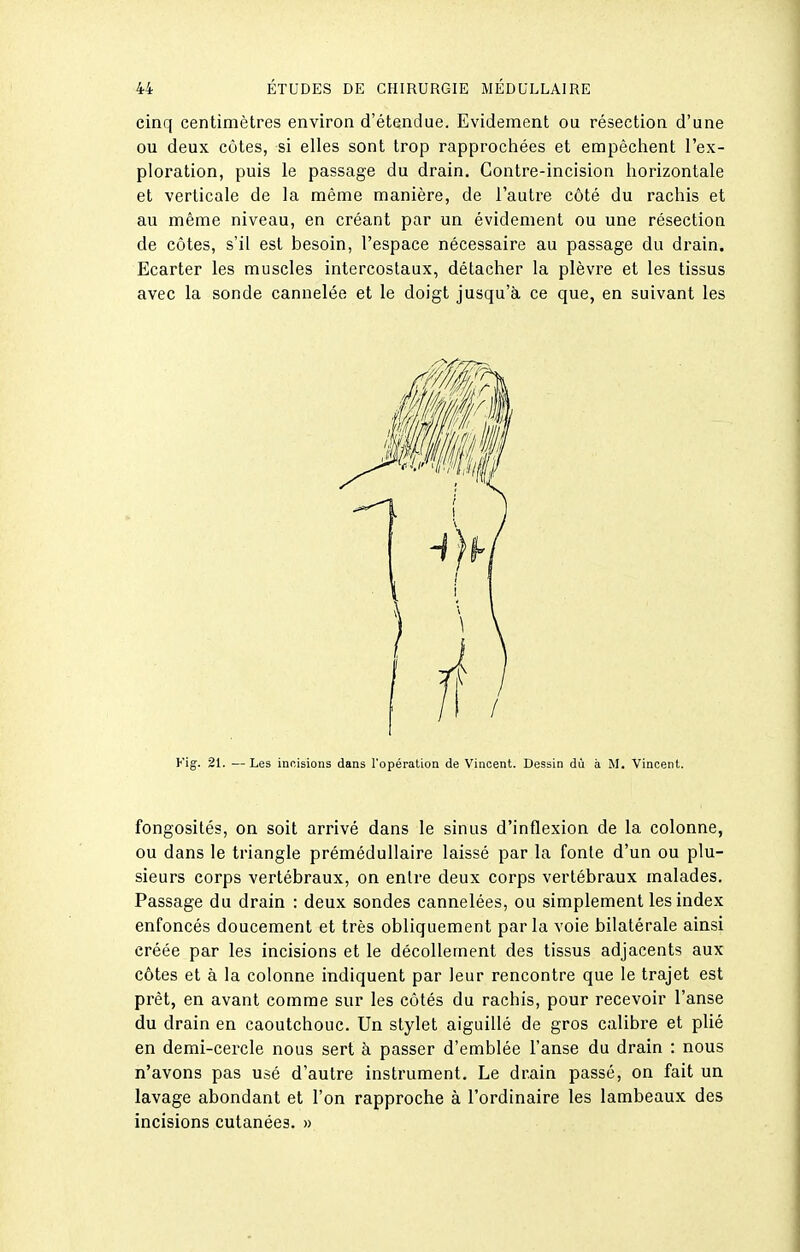 cinq centimètres environ d'étendue. Evideinent ou résection d'une ou deux côtes, si elles sont trop rapprochées et empêchent l'ex- ploration, puis le passage du drain. Contre-incision horizontale et verticale de la même manière, de l'autre côté du rachis et au même niveau, en créant par un évidement ou une résection de côtes, s'il est besoin, l'espace nécessaire au passage du drain. Ecarter les muscles intercostaux, détacher la plèvre et les tissus avec la sonde cannelée et le doigt jusqu'à ce que, en suivant les Fig. 21. —Les incisions dans l'opération de Vincent. Dessin dû à M. Vincent. fongosités, on soit arrivé dans le sinus d'inflexion de la colonne, ou dans le triangle prémédullaire laissé par la fonte d'un ou plu- sieurs corps vertébraux, on entre deux corps vertébraux malades. Passage du drain : deux sondes cannelées, ou simplement les index enfoncés doucement et très obliquement parla voie bilatérale ainsi créée par les incisions et le décollement des tissus adjacents aux côtes et à la colonne indiquent par leur rencontre que le trajet est prêt, en avant comme sur les côtés du rachis, pour recevoir l'anse du drain en caoutchouc. Un stylet aiguillé de gros calibre et plié en demi-cercle nous sert à passer d'emblée l'anse du drain : nous n'avons pas usé d'autre instrument. Le drain passé, on fait un lavage abondant et l'on rapproche à l'ordinaire les lambeaux des incisions cutanées. »