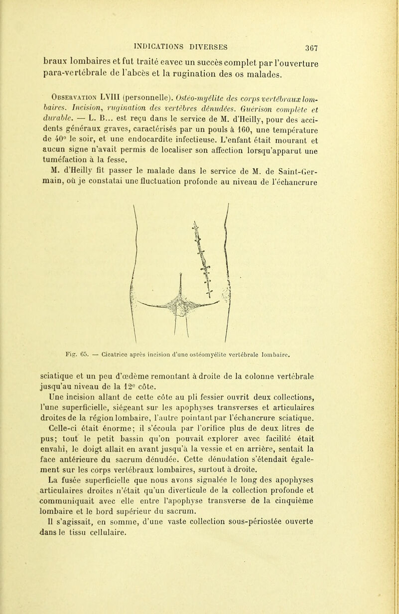 braux lombaires et fut traité eavec un succès complet par l'ouverture para-vertébrale de l'abcès et la rugination des os malades. Observation LVIII (personnelle). Ostéo-myélite des corps vertébraux lom- baires. Incision, rugination des vertèbres dénudées. Guérison complète et durable. — L. B... est reçu dans le service de M. d'Heilly, pour des acci- dents généraux graves, caractérisés par un pouls à 160, une température de 40° le soir, et une endocardite infectieuse. L'enfant était mourant et aucun signe n'avait permis de localiser son affection lorsqu'apparut une tuméfaction à la fesse. M. d'Heilly fit passer le malade dans le service de M. de Saint-Ger- main, où je constatai une fluctuation profonde au niveau de l'échancrure Fig. 65. — Cicatrice après incision d'une ostéomyélite vertébrale lombaire. sciatique et un peu d'oedème remontant adroite de la colonne vertébrale jusqu'au niveau de la 12'^ côte. Une incision allant de cette côte au pli fessier ouvrit deux collections, l'une superficielle, siégeant sur les apophyses transverses et articulaires droites de la région lombaire, l'autre pointant par l'échancrure sciatique. Celle-ci était énorme; il s'écoula par l'orifice plus de deux litres de pus; tout le petit bassin qu'on pouvait explorer avec facilité était envahi, le doigt allait en avant jusqu'à la vessie et en arrière, sentait la face antérieure du sacrum dénudée. Cette dénudation s'étendait égale- ment sur les corps vertébraux lombaires, surtout à droite. La fusée superficielle que nous avons signalée le long des apophyses articulaires droites n'était qu'un diverticule de la collection profonde et communiquait avec elle entre l'apophyse transverse de la cinquième lombaire et le bord supérieur du sacrum. 11 s'agissait, en somme, d'une vaste collection sous-périostée ouverte dans le tissu cellulaire.