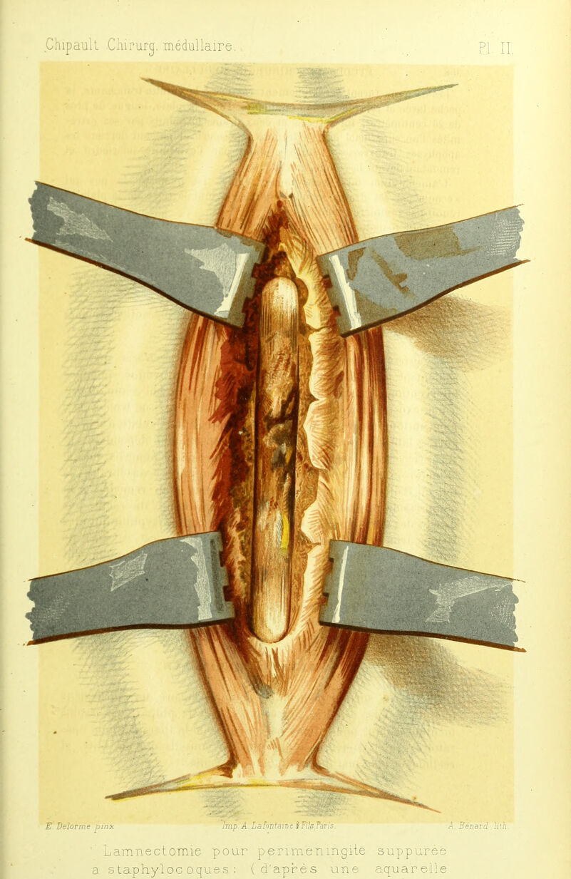 Chipaull Chirurg. médullaire PI II