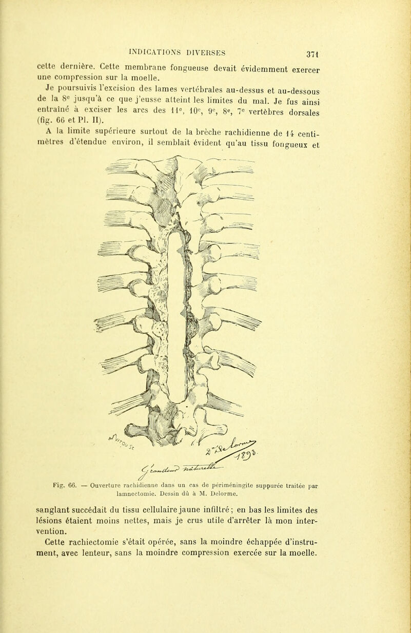 celte dernière. Cette membrane fongueuse devait évidemment exercer une compression sur la moelle. Je poursuivis l'excision des lames vertébrales au-dessus et au-dessous de la 8e jusqu'à ce que j'eusse atteint les limites du mal. Je fus ainsi entraîné à exciser les arcs des 11°, IQe, ge, 8, 7« vertèbres dorsales (fig. GO et Pl. II). A la limite supérieure surtout de la brèche rachidienne de 14 centi- mètres d'étendue environ, il semblait évident qu'au tissu fouo-ueux et Fig. 66. — Ouverture rachidienne dans un cas de périméningile suppurée traitée par lamnectomie. Dessin dù à M. Delorme. sanglant succédait du tissu cellulaire jaune infiltré; en bas les limites des lésions étaient moins nettes, mais je crus utile d'arrêter là mon inter- vention. Cette rachiectomie s'était opérée, sans la moindre échappée d'instru- ment, avec lenteur, sans la moindre compression exercée sur la moelle.