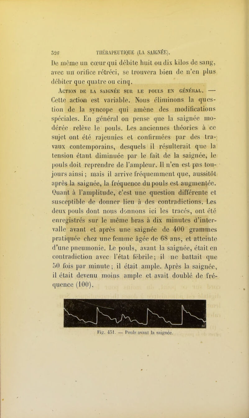 320 THÉRAPEUTIQUE (LA SAIGNÉE). De môme un cœur qui débite huit ou dix kilos de sang, avec un orifice rétréci, se trouvera bien de n'en plus débiter que quatre ou cinq. Action de la saignée sur le pouls en général. — Cette action est variable. Nous éliminons la ques- tion de la syncope qui amène des modifications spéciales. En général on pense que la saignée mo- dérée relève le pouls. Les anciennes théories à ce sujet ont été rajeunies et confirmées par des tra- vaux contemporains, desquels il résulterait que la tension étant diminuée par le fait de la saignée, le pouls doit reprendre de l'ampleur. Il n'en est pas tou- jours ainsi ; mais il arrive fréquemment que, aussitôt après la saignée, la fréquence du pouls est augmentée. Quant à l'amplitude, c'est une question différente et susceptible de donner lieu à des contradictions. Les deux pouls dont nous donnons ici les tracés, ont été enregistrés sur le même bras à dix minutes d'inter- valle avant et après une saignée de 400 grammes pratiquée chez une femme âgée de 68 ans, et atteinte d'une pneumonie. Le pouls, avant la saignée, était en contradiction avec l'état fébrile; il ne battait que 50 fois par minute; il était ample. Après la saignée, il était devenu moins ample et avait doublé de fré- quence (100). Fipr. 451. — Pouls avanl la saignée.