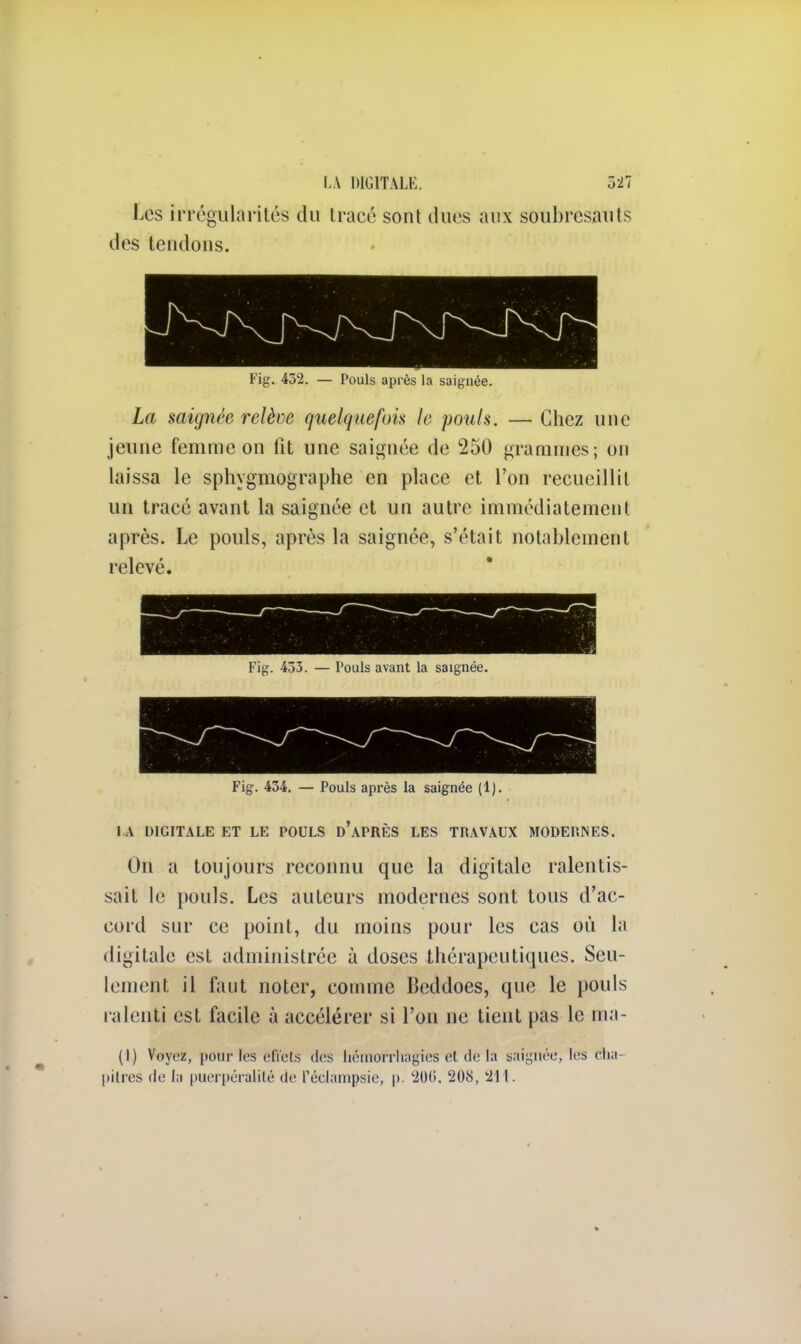 Les irrégularités du tracé sont dues aux soubresauts des tendons. Fig. 452. — Pouls après la saignée. La saignée relève quelquefois le pouls. — Chez une jeune femme on fît une saignée de 250 grammes; on laissa le sphygmographe en place et l'on recueillit un tracé avant la saignée et un autre immédiatement après. Le pouls, après la saignée, s'était notablement relevé. Fig. 453. — Pouls avant la saignée. Fig. 454. — Pouls après la saignée (1). LA DIGITALE ET LE POULS d'aPRÈS LES TRAVAUX MODERNES. On a toujours reconnu que la digitale ralentis- sait le pouls. Les auteurs modernes sont tous d'ac- cord sur ce point, du moins pour les cas où la digitale est administrée à doses thérapeutiques. Seu- lement il faut noter, comme Beddoes, que le pouls ralenti est facile à accélérer si l'on ne tient pas le ma- (1) Voyez, pour les effets des liémorrhagies et <!<• la saignée, les cha pitres de J;i puerpéralité de Péclâmpsie, p. 200, 208, 211.