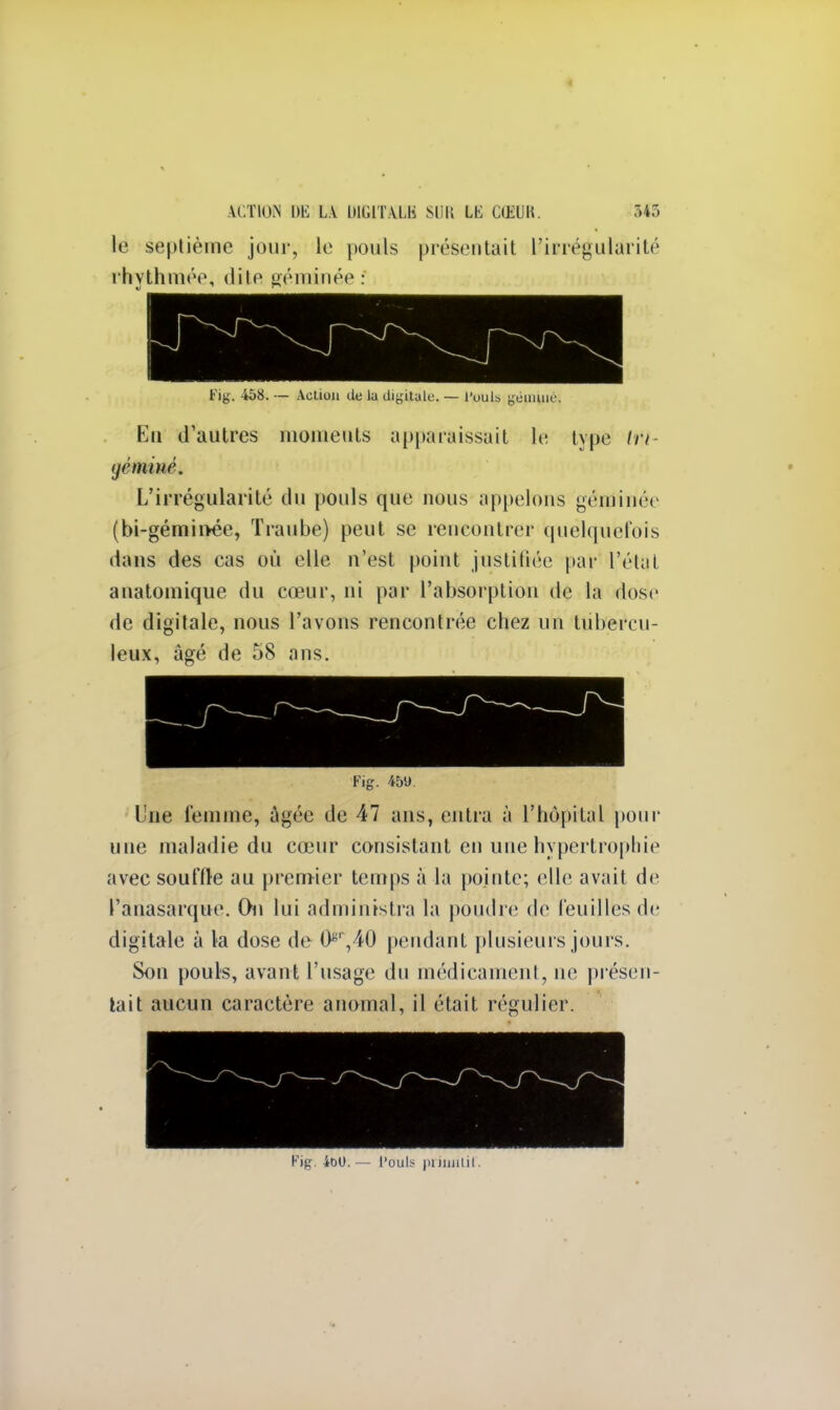 le septième jour, le pouls présentait l'irrégularité rhythmée, dite géminée : Fig, 458. — Action de la digitale. — l'uuls géminé. Eu d'autres moments apparaissait le type tri géminé. L'irrégularité du pouls que nous appelons géminée (bi-gémin-ée, Traube) peut se rencontrer quelquefois dans des cas où elle n'est point justifiée par l'étal anatomique du cœur, ni par l'absorption de la dose de digitale, nous l'avons rencontrée chez un tubercu- leux, âgé de 58 ans. Fig. 459. Une femme, âgée de 47 ans, entra à l'hôpital pour une maladie du cœur consistant en une hypertrophie avec souffle au premier temps à la pointe; elle avait de l'anasarque. On lui administra la poudré de feuilles de digitale à la dose de Or,40 pendant plusieurs jours. Son pouls, avant l'usage du médicament, ne présen- tait aucun caractère anomal, il était régulier. Fig. ioU.— l'ouls primitif.