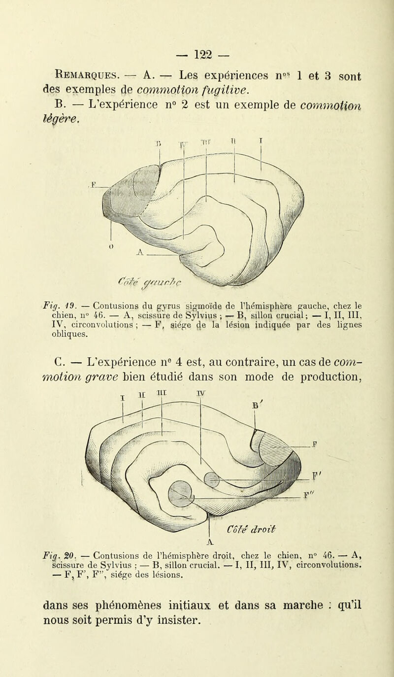 Remarques. — A. — Les expériences n0^ 1 et 3 sont des exemples de commotion fugitive. B. — L’expérience n° 2 est un exemple de commotion légère. Côfe ÿ'iunJiç Fig. 19. — Contusions du gyrus sigmoïde de l’hémisphère gauche, chez le chien, n° 46. — A, scissure de Sylvius ; «— B, sillon crucial; — I, II, III, IV, circonvolutions ; — F, siège ç[e la lésion indiquée par des lignes obliques. C. — L’expérience 11e 4 est, au contraire, un cas de com- motion grave bien étudié dans son mode de production, Fig. 20. — Contusions de l’hémisphère droit, chez le chien, n° 46. — A, scissure de Sylvius ; — B, sillon crucial. — I, II, III, IV, circonvolutions. — F, F’, F”, siège des lésions. dans ses phénomènes initiaux et dans sa marche : qu’il nous soit permis d’y insister.