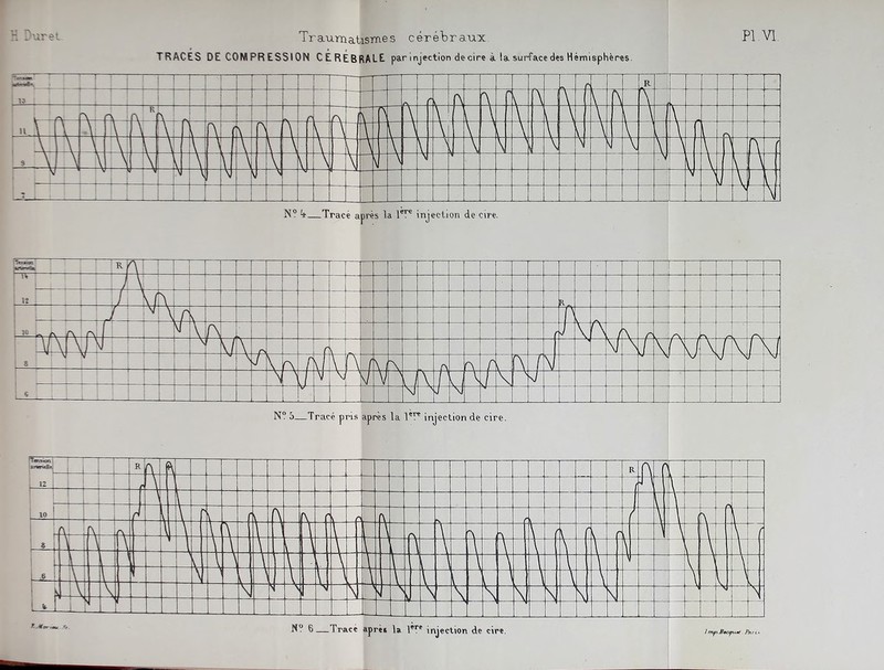 TRACES DECOMPRESSION CEREBRALE par injection decire à la surfacedes Hémisphères. fera r p\ ! TT 1 ' 1 -j— i~i ■. J- A 12 * j T \/T\ —i— —i— !r . — — ■ P v -1? ^ A f\ - ■ 1 i ■ | A' Al AL LU- À -S Nr ; \—Y 8 |_L r\ f\[\ \ r\ K f jr l i v v V TA A Ar , e T N vf * _ N° 5—Tracé pris après la Ie injection de cire. N? 6—Trace âpre» la 1*” injection de cire. /mp.BtcxpiM . Paris