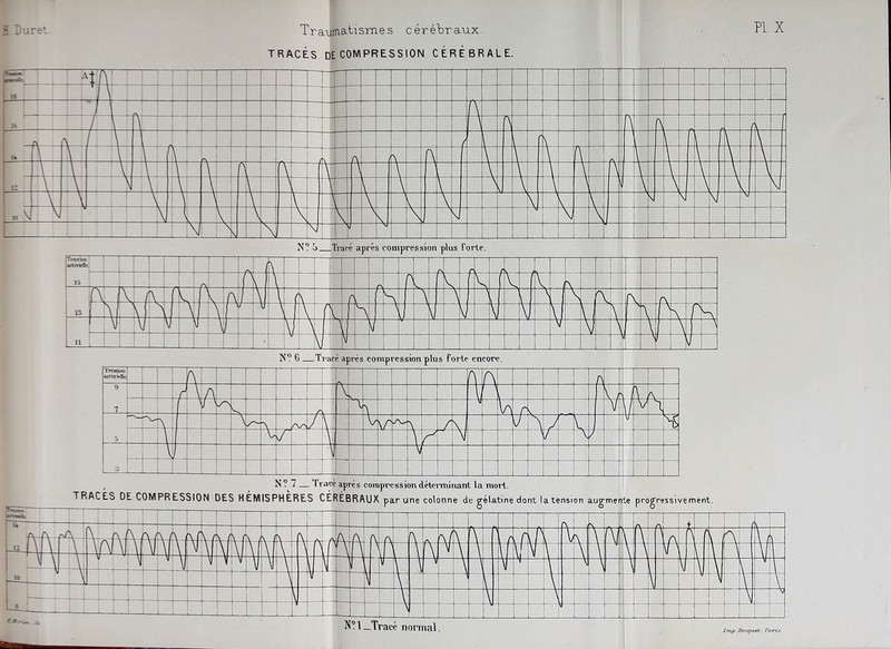 Traumatismes cérébraux. TRACÉS DECOMPRESSION CÉRÉBRALE. PI X N? —Tracé après compression plus forte encore.
