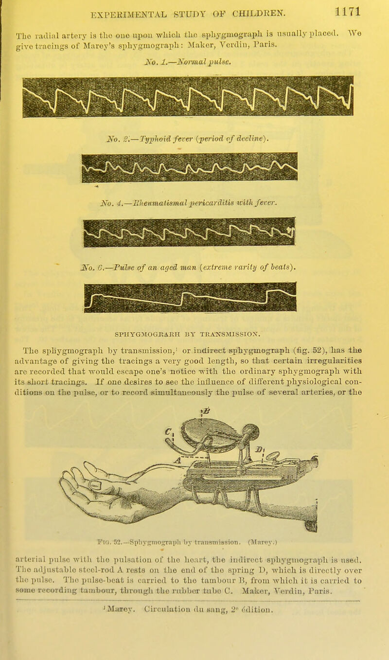 Tbo radial artery is tlio one upon wliicLi ilio spliygmograpli is usually placed. We give tracings of Maroy's spbygmograpli: Malccr, Ycrdiii, I'aris. jS'o. 1.—Normal 2) uUe. No. 2'.—Typhoid ftver {period of decline). No. 4.—llhmmai'mnal pmcardiUs lUth/ever. N'o. C.—Fulse of an aged man {extreme rarity of heats). SFIIYGMOGKARH HY TRANSMISSIOX. Tlie spliygmograph by transmission,' or indirect sphygmograph (fig. 52), has tke advantage of giving the tracings a very good length, so that certain irregularities are recorded that would escape one's notice with the ordinary sphygmograph with its short tracings. If one desires to see the influence of different physiological con- ditions on the pulse, or to record simultaucously the pulse of several arteries,, or the I'^IG. 52.—Splij'gniograiili liy Irnnstnission. (Marey.) rterial pulse with tl)0 pulsation of tlie lioart, the indirect sphygmograph is used. ho adjustable steel-rod A rests on the end of the spring D, which is directly over 0 pnlse. Tlio pulso-beat is carried to the tambour B, from which it is carried to me recording tambour, through the mbber tube C. Maker, Verdiu, Paris. J Marey. Circulation du sang, 2 dditiou.