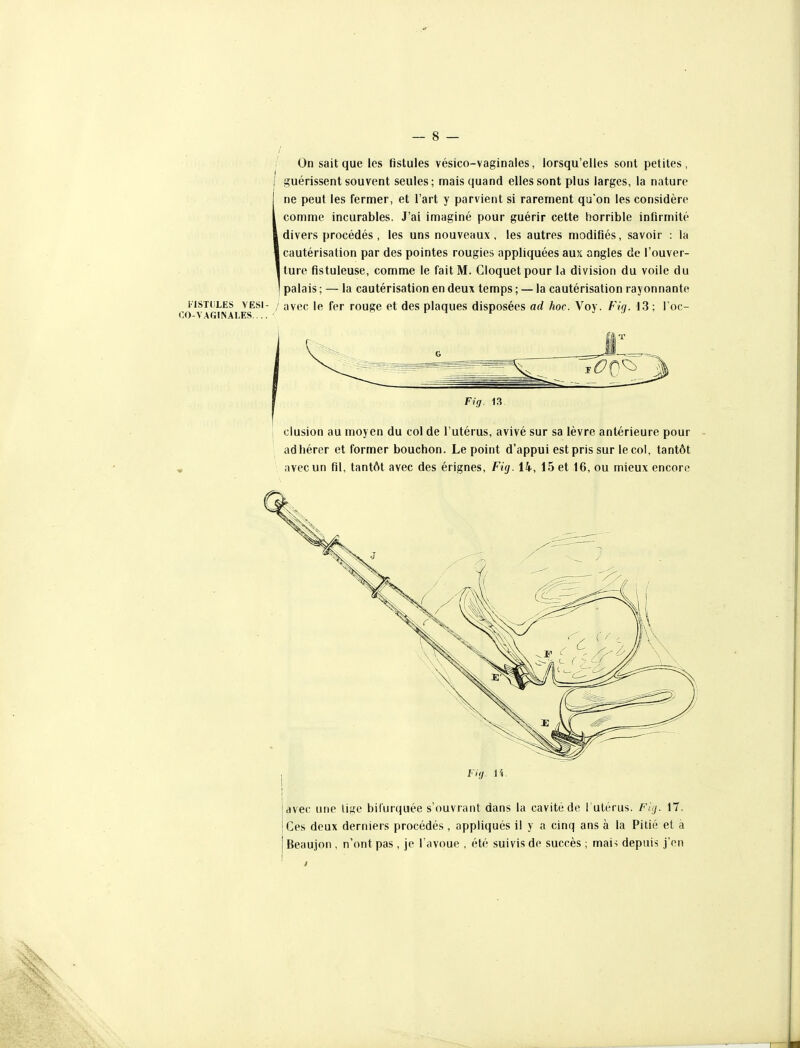 / ' On sait que les fistules vésico-vaginales, lorsqu'elles sont petites, ( guérissent souvent seules; mais quand elles sont plus larges, la nature j ne peut les fermer, et l'art y parvient si rarement qu'on les considère 1 comme incurables. J'ai imaginé pour guérir cette horrible infirmité I divers procédés , les uns nouveaux, les autres modifiés, savoir : la I cautérisation par des pointes rougies appliquées aux angles de l'ouver- I ture fistuleuse, comme le fait M. Cloquetpour la division du voile du 1 palais ; — la cautérisation en deux temps ; — la cautérisation rayonnante FISTULES VESi- / avBC le fer rouge et des plaques disposées ad hoc. Voy. Fin. 13; l'oc- Fi g. 13 i clusion au moyen du col de l'utérus, avivé sur sa lèvre antérieure pour - adhérer et former bouchon. Le point d'appui est pris sur le col, tantôt avec un fil, tantôt avec des érignes, Fig. 14, 15 et 16, ou mieux encore l-ig. 14. avec une lige bifurquée s'ouvrant dans la cavité de I utérus. F/.y. 17. Ces deux derniers procédés , appliqués il y a cinq ans à la Pitié et a Beaujon , n'ont pas , je l'avoue , été suivis do succès ; mai-; depuis j'en