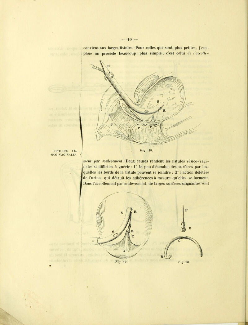 convient aux larges fistules. Pour celles qui sont plus petites, j'em- ploie un procédé beaucoup plus simple, c'est celui de l'accolle- \ment par soulèvement. Deux causes rendent les fistules vésico-vagi- Inales si difficiles à guérir: 1° le peu d'étendue des surfaces par les- jquelles les bords de la fistule peuvent se joindre ; 2'' l'action délétère jde l'urine, qui détruit les adhérences à mesure qu'elles se forment. [DansTaccollement par soulèvement, de larges surfaces saignantes sont Fiij 19. Fig. 20.