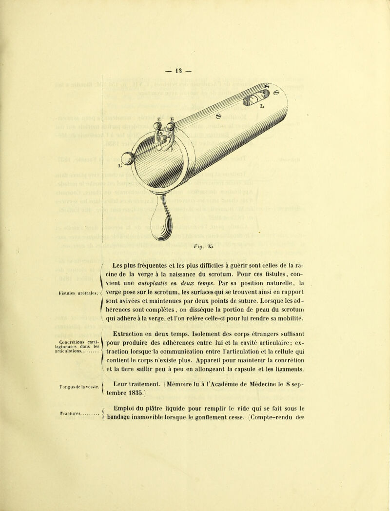 / Les plus fréquentes et les plus difficiles à guérir sont celles de la ra- I ci ne de la verge à la naissance du scrotum. Pour ces fistules, con- \ vient une autoplastie en deux temps. Par sa position naturelle, la Fistules urciraies. < vcrge pose sur le scrotum, les surfaces qui se trouvent ainsi en rapport sont avivées et maintenues par deux points de suture. Lorsque les ad- hérences sont complètes, on dissèque la portion de peau du scrotum qui adhère à la verge, et l'on relève celle-ci pour lui rendre sa mobilité. / Extraction en deux temps. Isolement des corps étrangers suffisant Concrétions caiii-1 pour produire des adhérences entre lui et la cavité articulaire; ex- igmeusos dans les j ' articulations \ traction lorsquc la communication entre l'articulation et la cellule qui contient le corps n'existe plus. Appareil pour maintenir la concrétion et la faire saillir peu à peu en allongeant la capsule et les ligaments. Fongusde la vessie. Leur traitement. (Mémoire lu à l'Académie de Médecine le 8 sep- tembre 1835.^ Fractures. Emploi du plâtre liquide pour remplir le vide qui .se fait sous le bandage inamovible lorsque le gonflement cesse. (Compte-rendu des