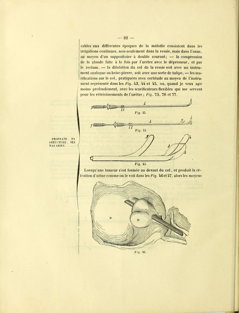 cables aux différentes époques de la maladie consistent dans les irrigations continues, non-seulement dans la vessie, mais dans l'anus, au moyen d'un suppositoire à double courant; — la compression de la glande faite à la fois par l'urètre avec le dépresseur, et par le rectum, — la dilatation du col de la vessie soit avec un instru- ment analogue au brise-pierre, soit avec une sorte de tulipe, — les sca- rifications sur le col, pratiquées avec certitude au moyen de l'instru- / ment représenté dans les Fig. 43, 44 et 45, ou, quand je veux agir ' moins profondément, avec les scarificateurs flexibles qui me servent pour les rétrécissements de l'urètre ; Fig. 75, 76 et 77.