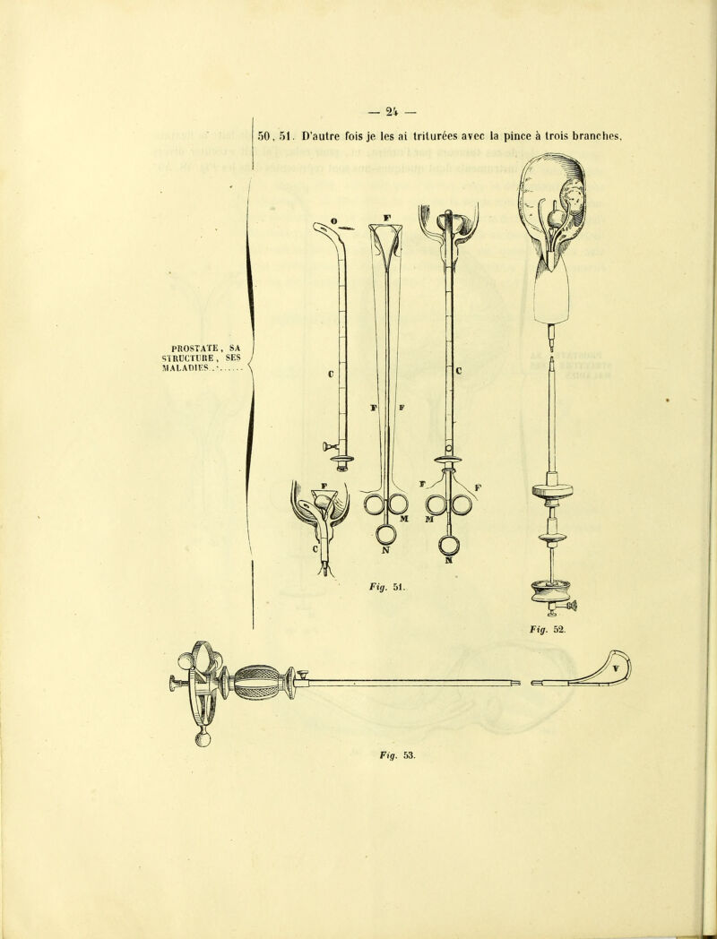 50, 51. D'autre fois je les ai triturées avec la pince à trois branches, Pig. 53.