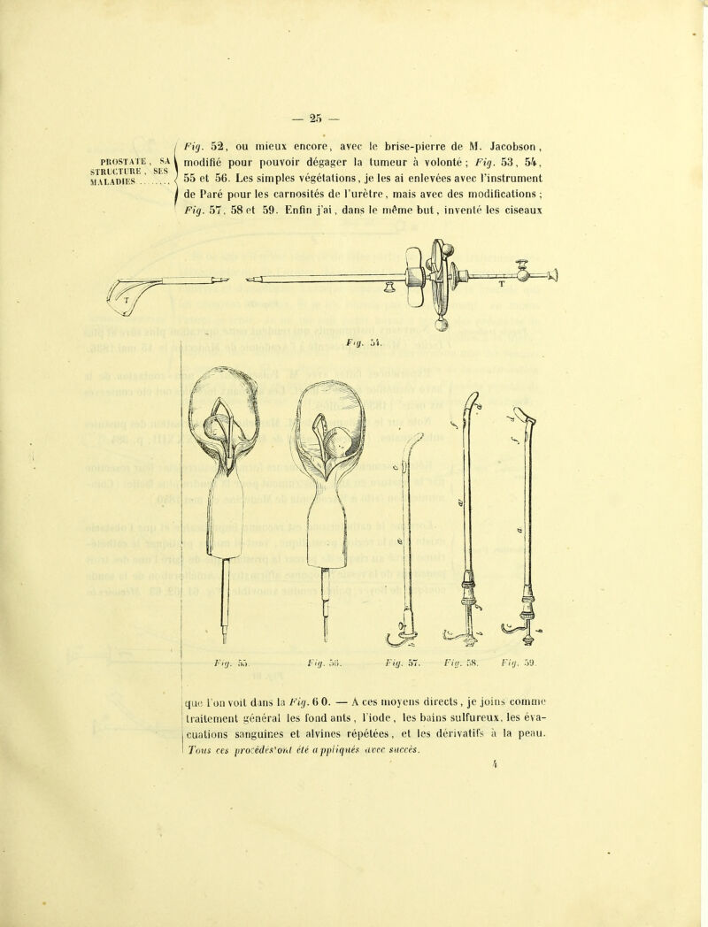!Fig. 52, ou mieux encore, avec le brise-pierre de M. Jacobson , modifié pour pouvoir dégager la tumeur à volonté; Fig. 53, hk, 55 et 56. Les simples végétations, je les ai enlevées avec l'instrument de Paré pour les carnosités de l'urètre, mais avec des modifications ; Fig. 57, 58 et 59. Enfin j'ai, dans le même but, inventé les ciseaux 1 ■ que l'on voit dans la Fig. 6 0. — A ces moyens directs , je joins comme traitement général les fond ants , l'iode, les bains sulfureux, les éva- cuations sanguines et alvines répétées, et les dérivatifs à la peau. Tous ces procédé.'!'ont été appliqtiés avec succès. fi