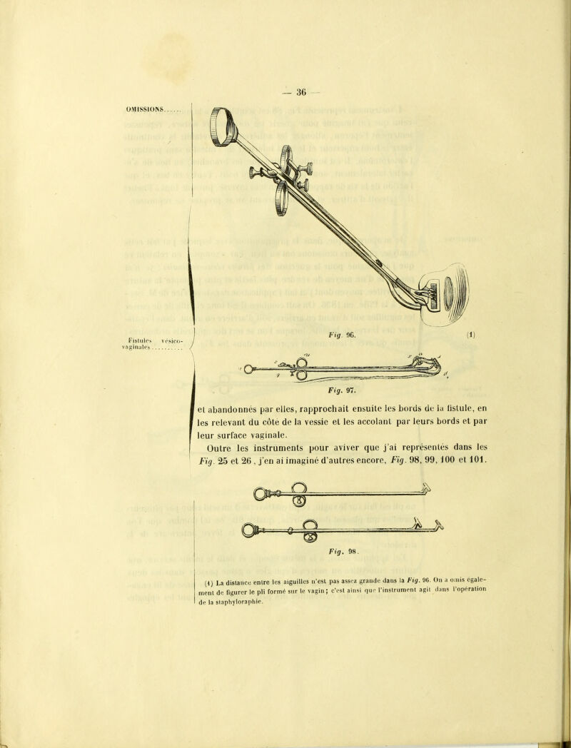 OMISSIONS. Fislulos vésico- vaginiiles Fig. 97. et abandonnés par elles, rapprochait ensuite les bords de lu fistule, en les relevant du côte de la vessie et les accolant par leurs bords et par leur surface vaginale. Outre les instruments pour aviver que j'ai représentés dans les Fig.^b et 26, j'en ai imaginé d'autres encore, inj. 98, 99, 100 et 101. Fig. 98. (1) La dislanco entre les aiguilles n'est pas assez grande dans la Fig. 96. On a omis égale- ment do figurer le pli formé sur le vagin; c'est ainsi que l'instrument agit dans l'opération de la slaphylorapiiie. U