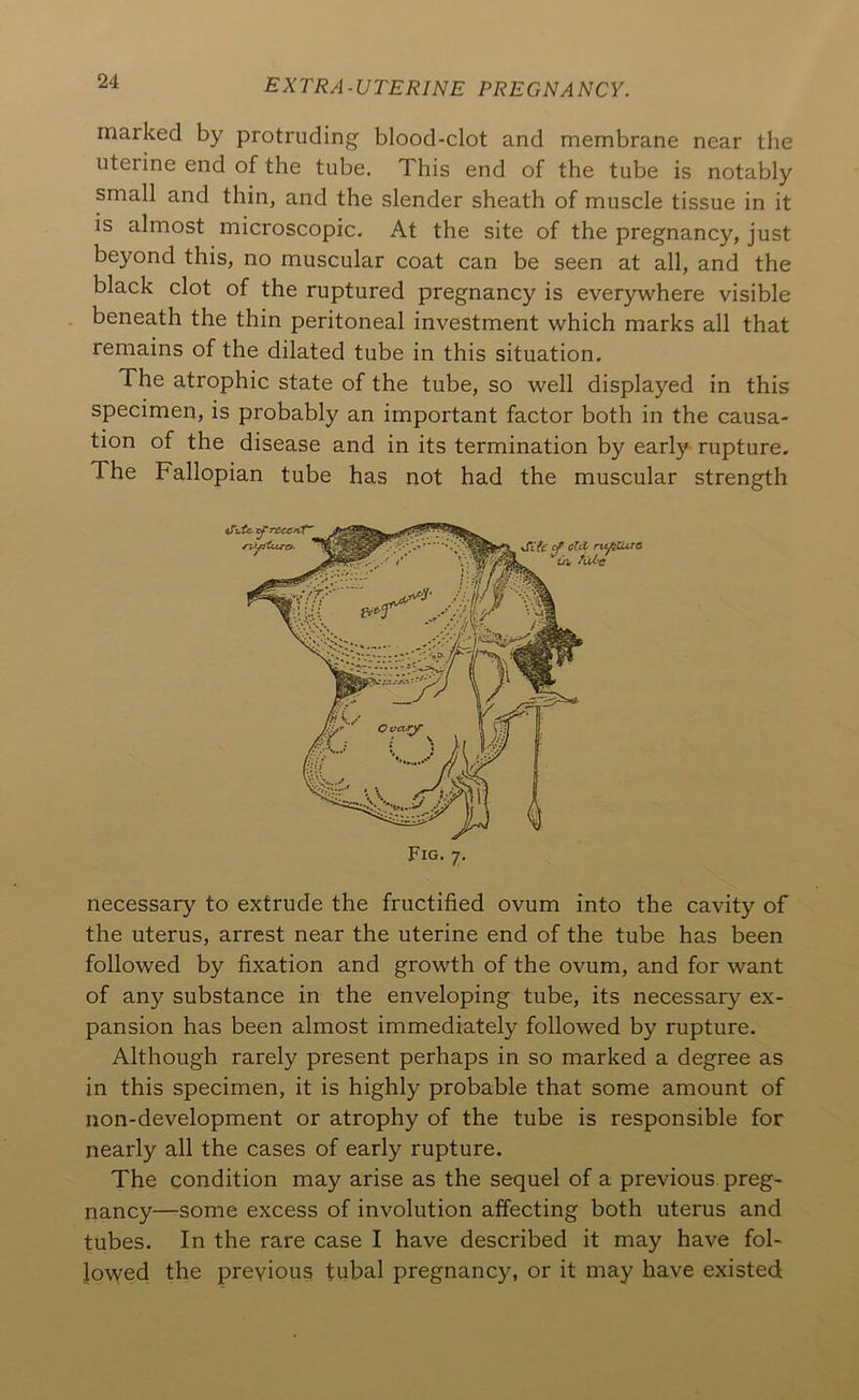 marked by protruding blood-clot and membrane near the uterine end of the tube. This end of the tube is notably small and thin, and the slender sheath of muscle tissue in it is almost microscopic. At the site of the pregnancy, just beyond this, no muscular coat can be seen at all, and the black clot of the ruptured pregnancy is everywhere visible beneath the thin peritoneal investment which marks all that remains of the dilated tube in this situation. The atrophic state of the tube, so well displayed in this specimen, is probably an important factor both in the causa- tion of the disease and in its termination by early rupture. The Fallopian tube has not had the muscular strength necessary to extrude the fructified ovum into the cavity of the uterus, arrest near the uterine end of the tube has been followed by fixation and growth of the ovum, and for want of any substance in the enveloping tube, its necessary ex- pansion has been almost immediately followed by rupture. Although rarely present perhaps in so marked a degree as in this specimen, it is highly probable that some amount of non-development or atrophy of the tube is responsible for nearly all the cases of early rupture. The condition may arise as the sequel of a previous preg- nancy—some excess of involution affecting both uterus and tubes. In the rare case I have described it may have fol- lowed the previous tubal pregnancy, or it may have existed