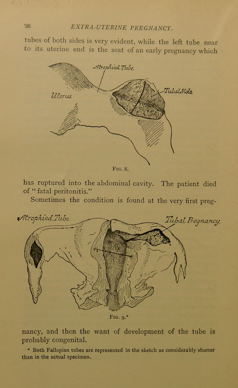 -26 tubes of both sides is very evident, while the left tube near lo its uterine end is the seat of an early pregnancy which has ruptured into the abdominal cavity. The patient died of “ fatal peritonitis.” Sometimes the condition is found at the very first preg- ^/Itrop'kiexi. Tuhe ■ ^ ^luhaL Ire^ria.njc^_ Fig. g. nancy, and then the want of development of the tube is probably congenital. * Both Fallopian tubes are represented in the sketch as considerably shorter than in the actual specimen.