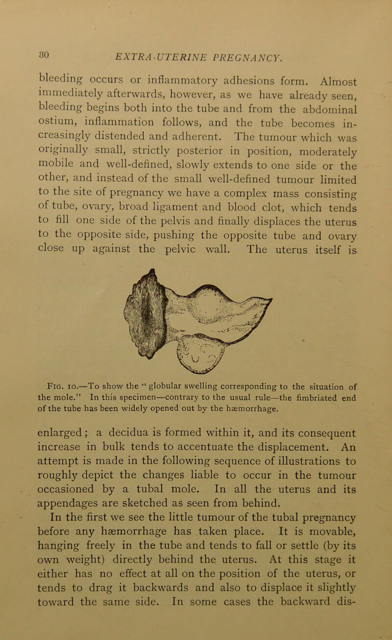 80 bleeding occurs or inflammatory adhesions form. Almost immediately afterwards, however, as we have already seen, bleeding begins both into the tube and from the abdominal ostium, inflammation follows, and the tube becomes in- creasingly distended and adherent. The tumour which was originally small, strictly posterior in position, moderately mobile and well-defined, slowly extends to one side or the other, and instead of the small well-defined tumour limited to the site of pregnancy we have a complex mass consisting of tube, ovary, broad ligament and blood clot, which tends to fill one side of the pelvis and finally displaces the uterus to the opposite side, pushing the opposite tube and ovary close up against the pelvic wall. The uterus itself is Fig. io.—To show the “ globular swelling corresponding to the situation of the mole.” In this specimen—contrary to the usual rule—the fimbriated end of the tube has been widely opened out by the haemorrhage. enlarged ; a decidua is formed within it, and its consequent increase in bulk tends to accentuate the displacement. An attempt is made in the following sequence of illustrations to roughly depict the changes liable to occur in the tumour occasioned by a tubal mole. In all the uterus and its appendages are sketched as seen from behind. In the first we see the little tumour of the tubal pregnancy before any haemorrhage has taken place. It is movable, hanging freely in the tube and tends to fall or settle (by its own weight) directly behind the uterus. At this stage it either has no effect at all on the position of the uterus, or tends to drag it backwards and also to displace it slightly toward the same side. In some cases the backward dis-