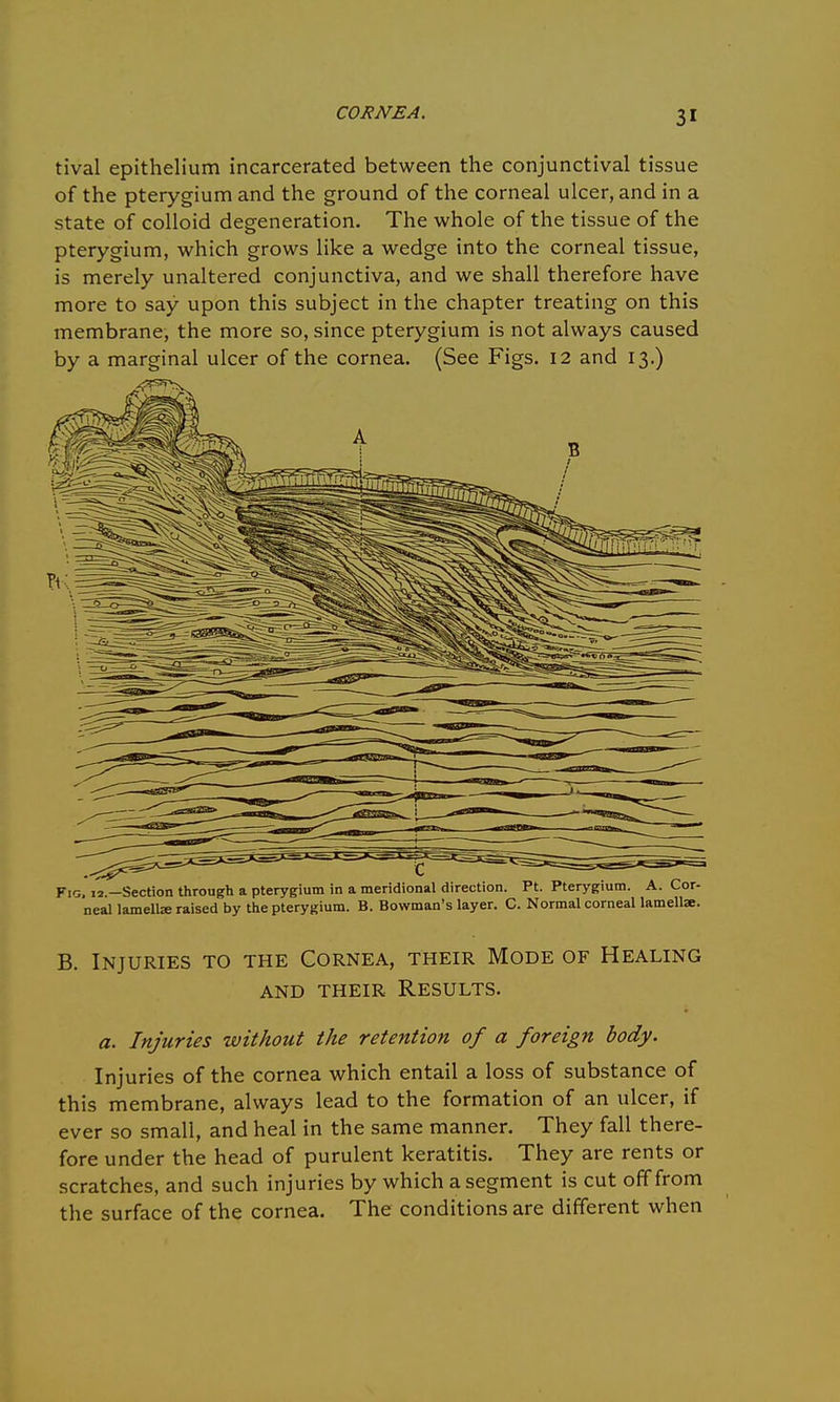 tival epithelium incarcerated between the conjunctival tissue of the pterygium and the ground of the corneal ulcer, and in a state of colloid degeneration. The whole of the tissue of the pterygium, which grows like a wedge into the corneal tissue, is merely unaltered conjunctiva, and we shall therefore have more to say upon this subject in the chapter treating on this membrane, the more so, since pterygium is not always caused by a marginal ulcer of the cornea. (See Figs. 12 and 13.) Fig, 12.—Section through a pterygium in a meridional direction. Pt. Pterygium. A. Cor- neal lamella; raised by the pterygium. B. Bowman's layer. C. Normal corneal lamellae. B. Injuries to the Cornea, their Mode of Healing AND THEIR RESULTS. a. Injuries without the retention of a foreign body. Injuries of the cornea which entail a loss of substance of this membrane, always lead to the formation of an ulcer, if ever so small, and heal in the same manner. They fall there- fore under the head of purulent keratitis. They are rents or scratches, and such injuries by which a segment is cut off from the surface of the cornea. The conditions are different when