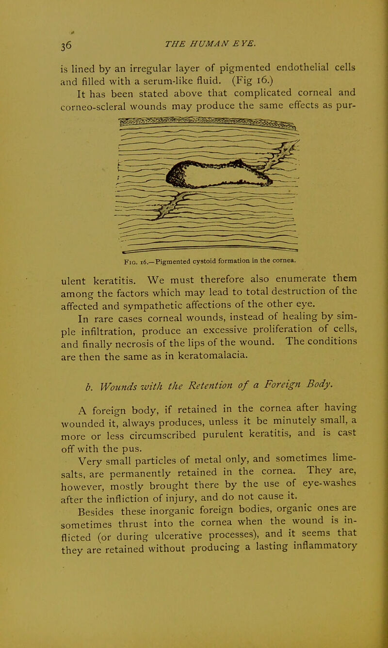 is lined by an irregular layer of pigmented endothelial cells and filled with a serum-like fluid. (Fig 16.) It has been stated above that complicated corneal and corneo-scleral wounds may produce the same effects as pur- Fig. i6.—Pigmented cystoid formation in the cornea. ulent keratitis. We must therefore also enumerate them among the factors which may lead to total destruction of the affected and sympathetic affections of the other eye. In rare cases corneal wounds, instead of healing by sim- ple infiltration, produce an excessive proliferation of cells, and finally necrosis of the lips of the wound. The conditions are then the same as in keratomalacia. b. Wounds with the Retention of a Foreign Body. A foreign body, if retained in the cornea after having wounded it, always produces, unless it be minutely small, a more or less circumscribed purulent keratitis, and is cast off with the pus. Very small particles of metal only, and sometimes lime- salts, are permanently retained in the cornea. They are, however, mostly brought there by the use of eye-washes after the infliction of injury, and do not cause it. Besides these inorganic foreign bodies, organic ones are sometimes thrust into the cornea when the wound is in- flicted (or during ulcerative processes), and it seems that they are retained without producing a lasting inflammatory