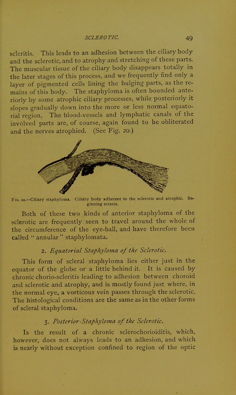 scleritis. This leads to an adhesion between the ciliary body and the sclerotic, and to atrophy and stretching of these parts. The muscular tissue of the ciliary body disappears totally in the later stages of this process, and we frequently find only a layer of pigmented cells lining the bulging parts, as the re- mains of this body. The staphyloma is often bounded ante- riorly by some atrophic ciliary processes, while posteriorly it slopes gradually down into the more or less normal equato- rial region. The blood-vessels and lymphatic canals of the involved parts are, of course, again found to be obliterated and the nerves atrophied. (See Fig. 20.) Fig. 20.—Ciliary staphyloma. Ciliary body adherent to the sclerotic and atrophic. Be- ginning ectasia. Both of these two kinds of anterior staphyloma of the sclerotic are frequently seen to travel around the whole of the circumference of the eye-ball, and have therefore been called  annular  staphylomata. 2. Equatorial Staphyloma of the Sclerotic. This form of scleral staphyloma lies either just in the equator of the globe or a little behind it. It is caused by chronic chorio-scleritis leading to adhesion between choroid and sclerotic and atrophy, and is mostly found just where, in the normal eye, a vorticous vein passes through the sclerotic. The histological conditions are the same as in the other forms of scleral staphyloma. 3. Posterior -Staphyloma of tlte Sclerotic. Is the result of- a chronic sclerochorioiditis, which, however, does not always leads to an adhesion, and which is nearly without exception confined to region of the optic