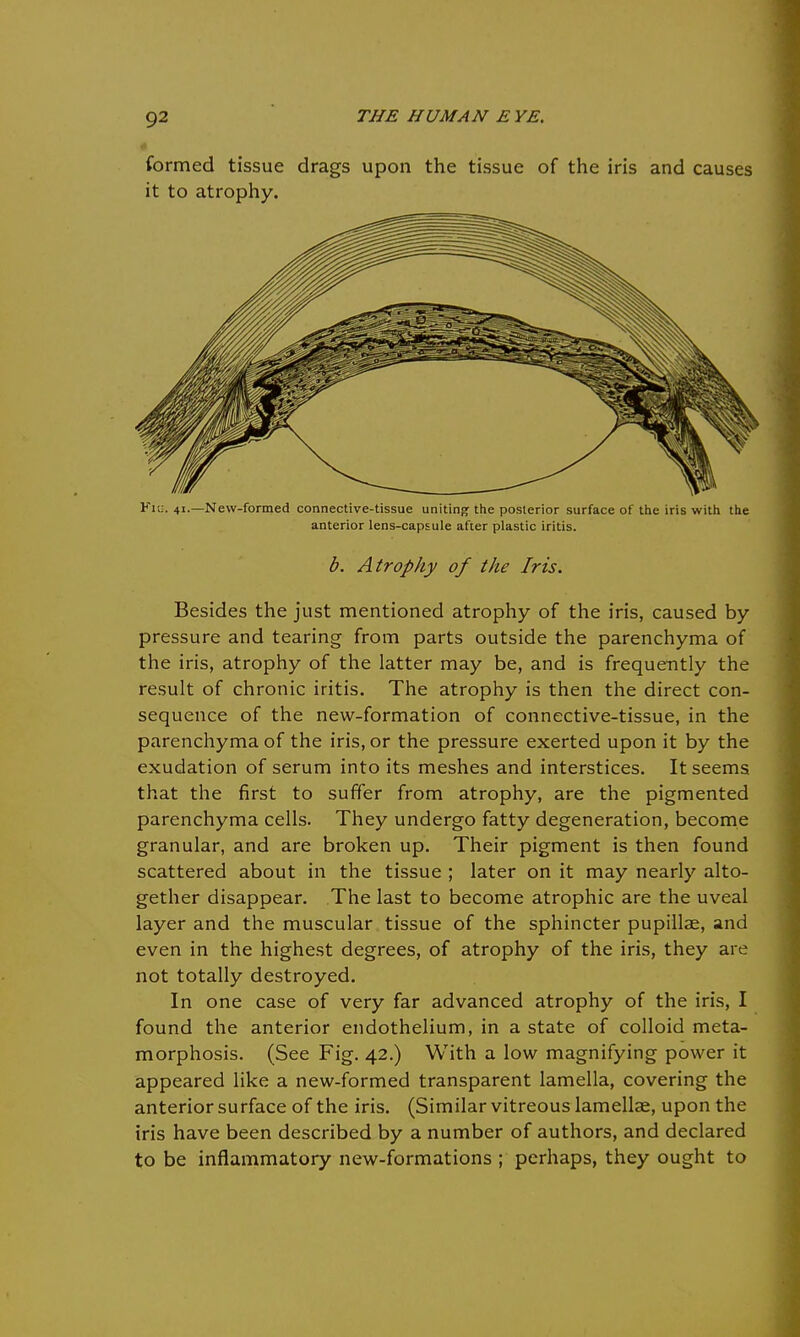 formed tissue drags upon the tissue of the iris and causes it to atrophy. Fiu. 41.—New-formed connective-tissue uniting the posterior surface of the iris with the anterior lens-capsule after plastic iritis. b. Atrophy of the Iris. Besides the just mentioned atrophy of the iris, caused by pressure and tearing from parts outside the parenchyma of the iris, atrophy of the latter may be, and is frequently the result of chronic iritis. The atrophy is then the direct con- sequence of the new-formation of connective-tissue, in the parenchyma of the iris, or the pressure exerted upon it by the exudation of serum into its meshes and interstices. It seems that the first to suffer from atrophy, are the pigmented parenchyma cells. They undergo fatty degeneration, become granular, and are broken up. Their pigment is then found scattered about in the tissue ; later on it may nearly alto- gether disappear. The last to become atrophic are the uveal layer and the muscular tissue of the sphincter pupilla^, and even in the highest degrees, of atrophy of the iris, they are not totally destroyed. In one case of very far advanced atrophy of the iris, I found the anterior endothelium, in a state of colloid meta- morphosis. (See Fig. 42.) With a low magnifying power it appeared like a new-formed transparent lamella, covering the anterior surface of the iris. (Similar vitreous lamellae, upon the iris have been described by a number of authors, and declared to be inflammatory new-formations ; perhaps, they ought to