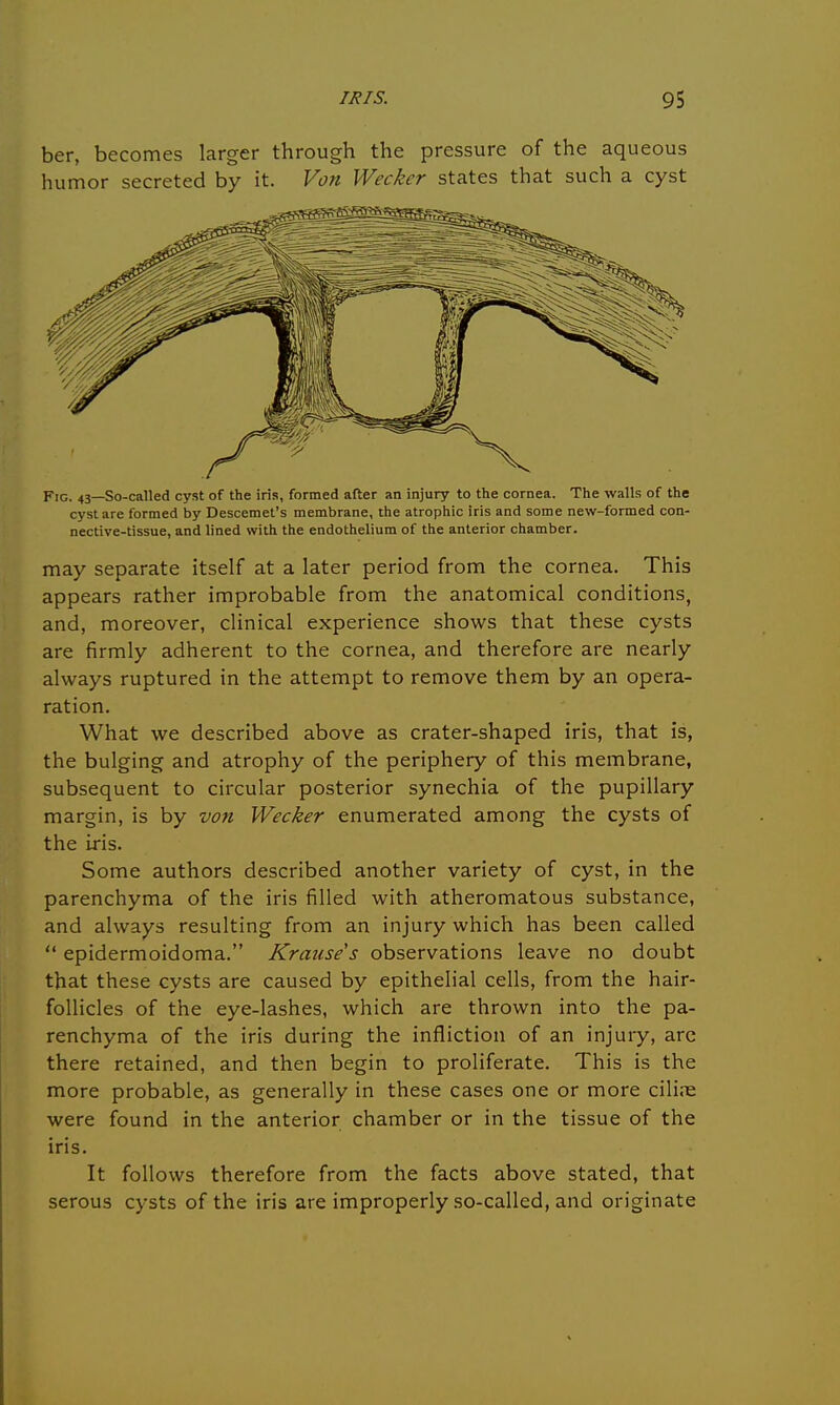 ber, becomes larger through the pressure of the aqueous humor secreted by it. Von Wecker states that such a cyst FIG. 43—So-called cyst of the iris, formed after an injury to the cornea. The walls of the cyst are formed by Descemet's membrane, the atrophic iris and some new-formed con- nective-tissue, and lined with the endothelium of the anterior chamber. may separate itself at a later period from the cornea. This appears rather improbable from the anatomical conditions, and, moreover, clinical experience shows that these cysts are firmly adherent to the cornea, and therefore are nearly always ruptured in the attempt to remove them by an opera- ration. What we described above as crater-shaped iris, that is, the bulging and atrophy of the periphery of this membrane, subsequent to circular posterior synechia of the pupillary margin, is by von Wecker enumerated among the cysts of the iris. Some authors described another variety of cyst, in the parenchyma of the iris filled with atheromatous substance, and always resulting from an injury which has been called  epidermoidoma. Krause's observations leave no doubt that these cysts are caused by epithelial cells, from the hair- follicles of the eye-lashes, which are thrown into the pa- renchyma of the iris during the infliction of an injury, are there retained, and then begin to proliferate. This is the more probable, as generally in these cases one or more cilire were found in the anterior chamber or in the tissue of the iris. It follows therefore from the facts above stated, that serous cysts of the iris are improperly so-called, and originate