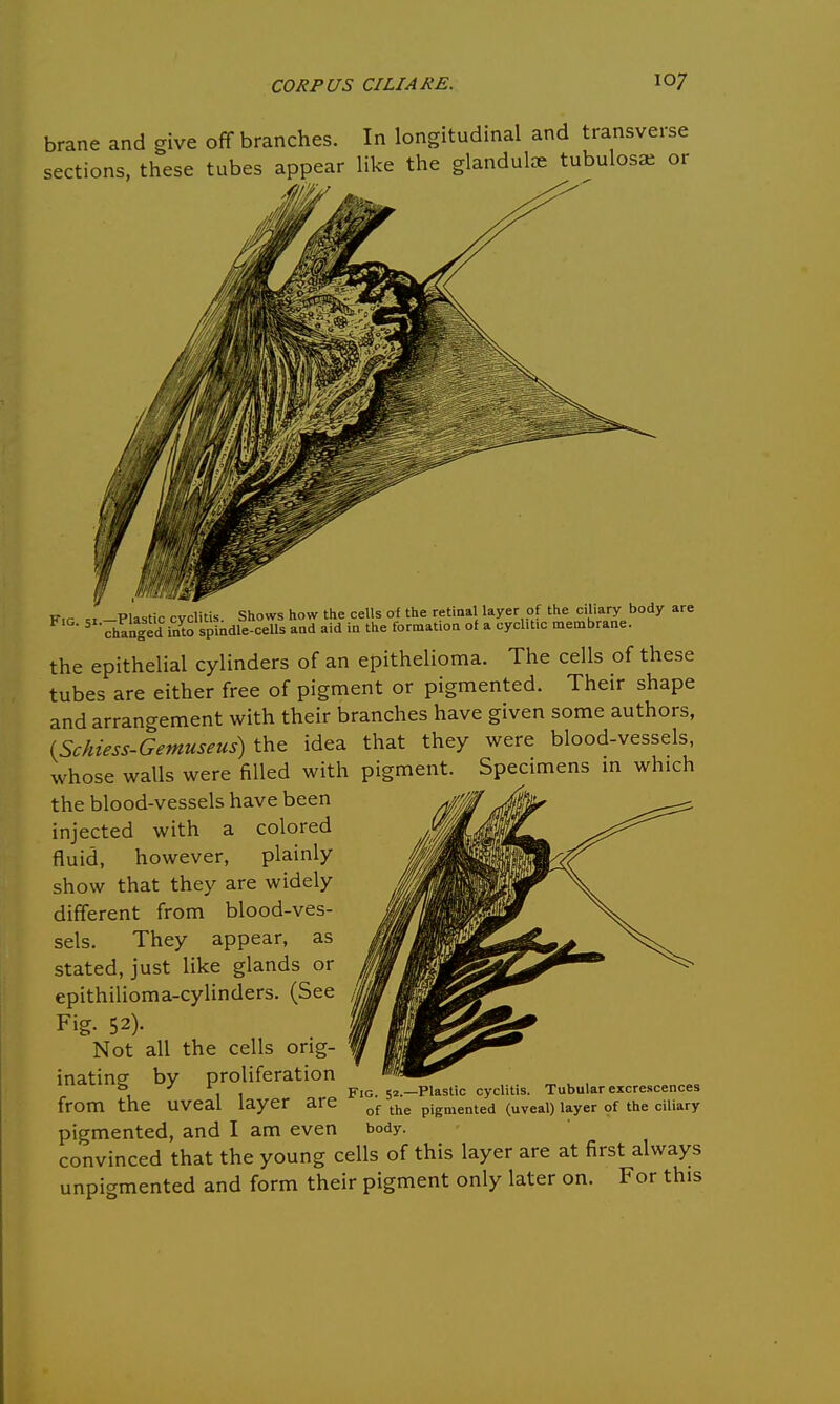 brane and give off branches. In longitudinal and transverse sections, these tubes appear like the glandulce tubulos* or F,r « -Plastic cvclitis Shows how the cells of the retinal layer of the ciliary body are 5 Changedf So spindle-cells and aid in the formation of a cycht.c membrane. the epithelial cylinders of an epithelioma. The cells of these tubes are either free of pigment or pigmented. Their shape and arrangement with their branches have given some authors, (ScAtess-Gemuseus) the idea that they were blood-vessels, whose walls were filled with pigment. Specimens in which the blood-vessels have been injected with a colored fluid, however, plainly show that they are widely different from blood-ves- sels. They appear, as stated, just like glands or epithilioma-cylinders. (See Fig. 52). Not all the cells orig- inating by proliferation from the uveal layer pigmented, and I am even convinced that the young cells of this layer are at first always unpigmented and form their pigment only later on. For this Fig. 52.—Plastic cyclitis. Tubular excrescences of the pigmented (uveal) layer of the ciliary body.