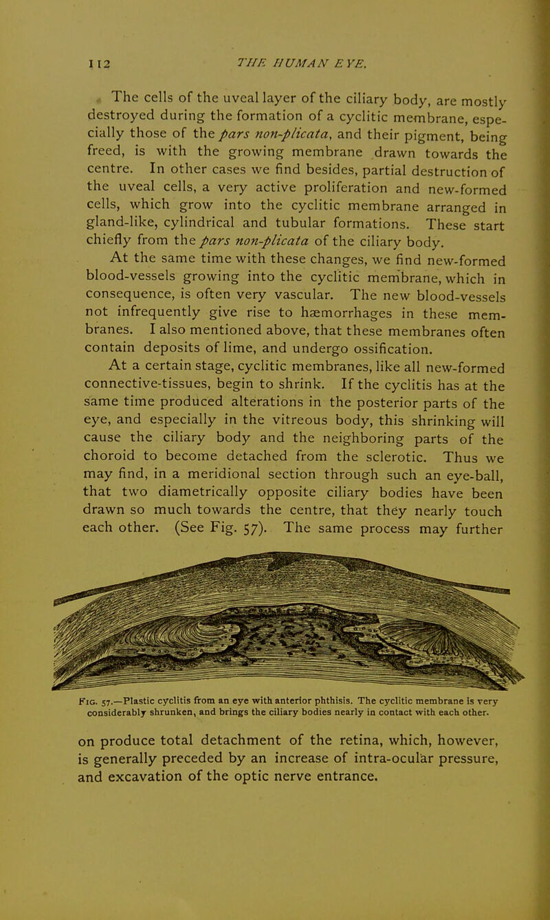 The cells of the uveal layer of the ciliary body, are mostly destroyed during the formation of a cyclitic membrane, espe- cially those of the pars non-plicata, and their pigment, being freed, is with the growing membrane drawn towards the centre. In other cases we find besides, partial destruction of the uveal cells, a very active proliferation and new-formed cells, which grow into the cyclitic membrane arranged in gland-like, cylindrical and tubular formations. These start chiefly from the pars non-plicata of the ciliary body. At the same time with these changes, we find new-formed blood-vessels growing into the cyclitic membrane, which in consequence, is often very vascular. The new blood-vessels not infrequently give rise to haemorrhages in these mem- branes. I also mentioned above, that these membranes often contain deposits of lime, and undergo ossification. At a certain stage, cyclitic membranes, like all new-formed connective-tissues, begin to shrink. If the cyclitis has at the same time produced alterations in the posterior parts of the eye, and especially in the vitreous body, this shrinking will cause the ciliary body and the neighboring parts of the choroid to become detached from the sclerotic. Thus we may find, in a meridional section through such an eye-ball, that two diametrically opposite ciliary bodies have been drawn so much towards the centre, that they nearly touch each other. (See Fig. 57). The same process may further Fig. 57.—Plastic cyclitis from an eye with anterior phthisis. The cyclitic membrane is very considerably shrunken, and brings the ciliary bodies nearly in contact with each other. on produce total detachment of the retina, which, however, is generally preceded by an increase of intra-ocular pressure, and excavation of the optic nerve entrance.