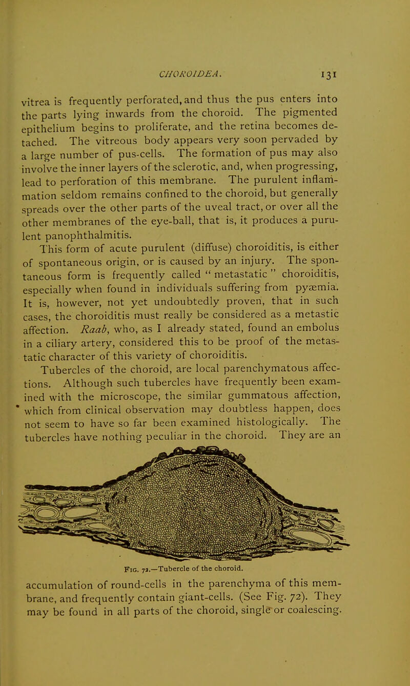 vitrea is frequently perforated, and thus the pus enters into the parts lying inwards from the choroid. The pigmented epithelium begins to proliferate, and the retina becomes de- tached. The vitreous body appears very soon pervaded by a large number of pus-cells. The formation of pus may also involve the inner layers of the sclerotic, and, when progressing, lead to perforation of this membrane. The purulent inflam- mation seldom remains confined to the choroid, but generally spreads over the other parts of the uveal tract, or over all the other membranes of the eye-ball, that is, it produces a puru- lent panophthalmitis. This form of acute purulent (diffuse) choroiditis, is either of spontaneous origin, or is caused by an injury. The spon- taneous form is frequently called  metastatic  choroiditis, especially when found in individuals suffering from pyaemia. It is, however, not yet undoubtedly proven, that in such cases, the choroiditis must really be considered as a metastic affection. Raab, who, as I already stated, found an embolus in a ciliary artery, considered this to be proof of the metas- tatic character of this variety of choroiditis. Tubercles of the choroid, are local parenchymatous affec- tions. Although such tubercles have frequently been exam- ined with the microscope, the similar gummatous affection, * which from clinical observation may doubtless happen, does not seem to have so far been examined histologically. The tubercles have nothing peculiar in the choroid. They are an Fig. 7j.—Tubercle of the choroid. accumulation of round-cells in the parenchyma of this mem- brane, and frequently contain giant-cells. (See Fig. 72). They may be found in all parts of the choroid, single or coalescing.