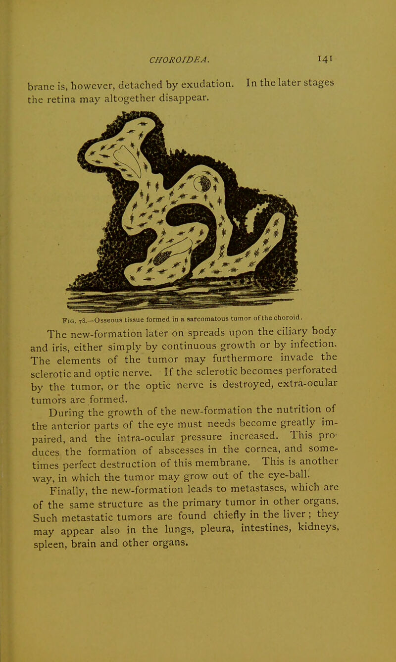 brane is, however, detached by exudation. In the later stages the retina may altogether disappear. Fig. 7S.—Osseous tissue formed in a sarcomatous tumor of the choroid. The new-formation later on spreads upon the ciliary body and iris, either simply by continuous growth or by infection. The elements of the tumor may furthermore invade the sclerotic and optic nerve. If the sclerotic becomes perforated by the tumor, or the optic nerve is destroyed, extra-ocular tumors are formed. During the growth of the new-formation the nutrition of tire anterior parts of the eye must needs become greatly im- paired, and the intra-ocular pressure increased. This pro- duces the formation of abscesses in the cornea, and some- times perfect destruction of this membrane. This is another way, in which the tumor may grow out of the eye-ball. Finally, the new-formation leads to metastases, which are of the same structure as the primary tumor in other organs. Such metastatic tumors are found chiefly in the liver; they may appear also in the lungs, pleura, intestines, kidneys, spleen, brain and other organs.