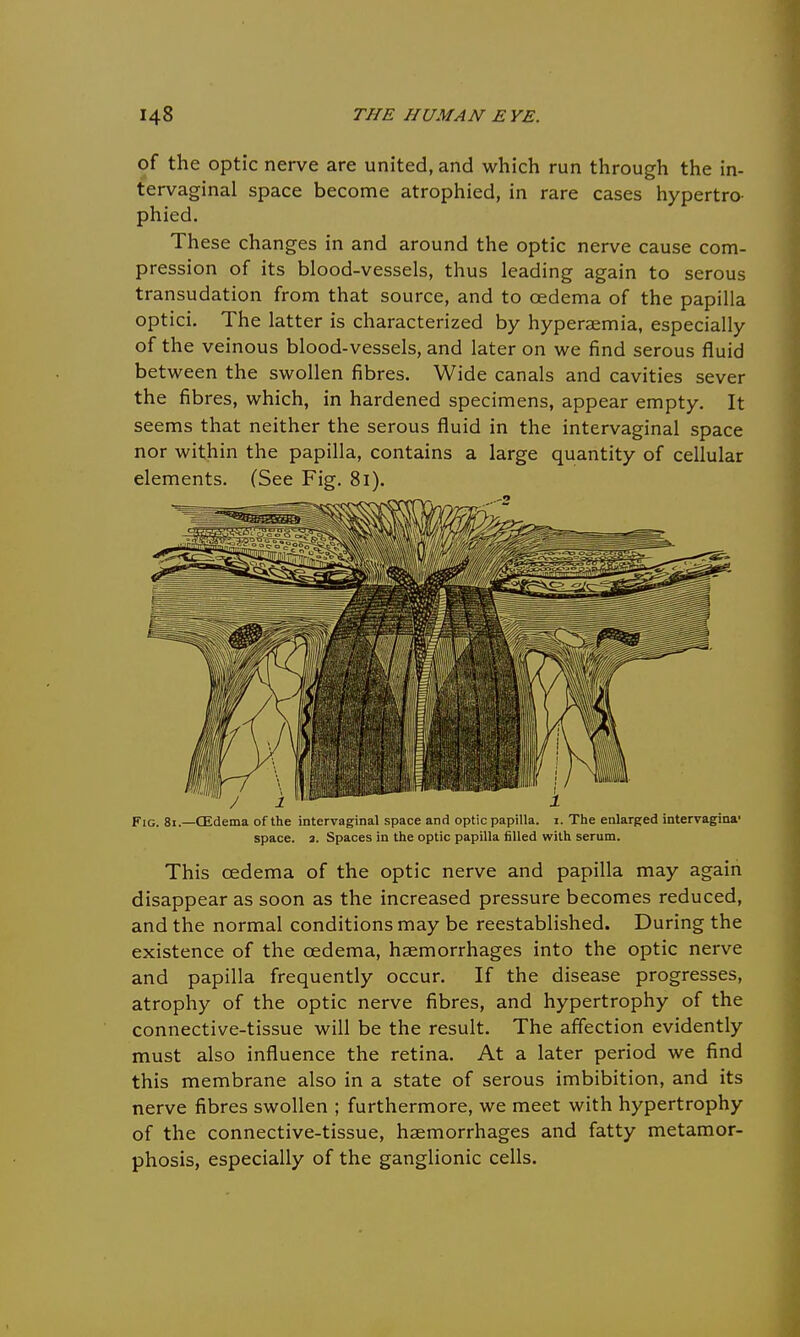 of the optic nerve are united, and which run through the in- tervaginal space become atrophied, in rare cases hypertro- phied. These changes in and around the optic nerve cause com- pression of its blood-vessels, thus leading again to serous transudation from that source, and to oedema of the papilla optici. The latter is characterized by hyperaemia, especially of the veinous blood-vessels, and later on we find serous fluid between the swollen fibres. Wide canals and cavities sever the fibres, which, in hardened specimens, appear empty. It seems that neither the serous fluid in the intervaginal space nor within the papilla, contains a large quantity of cellular elements. (See Fig. 81). / i 1 Fig. 81.—CEdema of the intervaginal space and optic papilla, i. The enlarged intervagina' space, a. Spaces in the optic papilla filled with serum. This oedema of the optic nerve and papilla may again disappear as soon as the increased pressure becomes reduced, and the normal conditions may be reestablished. During the existence of the oedema, haemorrhages into the optic nerve and papilla frequently occur. If the disease progresses, atrophy of the optic nerve fibres, and hypertrophy of the connective-tissue will be the result. The affection evidently must also influence the retina. At a later period we find this membrane also in a state of serous imbibition, and its nerve fibres swollen ; furthermore, we meet with hypertrophy of the connective-tissue, haemorrhages and fatty metamor- phosis, especially of the ganglionic cells.