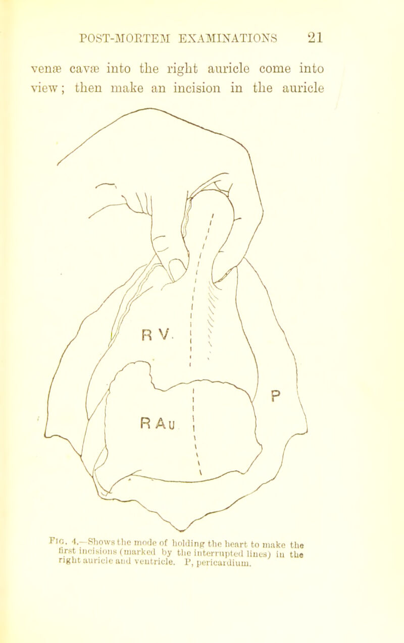 venfe cava3 into the right auricle come into view; then make an incision in the auricle Fio, 4—Showsthe modfi of li first inrisidiis (uiarkoil by right auricle and ventricle. Iding tlio hrarfc to inal^o tlm tlio intorniptuil liucsj in the P, lioricaidium.