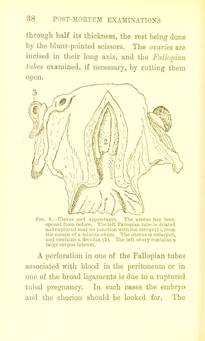 through half its thickness, the rest being done by the blunt-pointed scissors. The ovaries are incised in their long axis, and the Fallopian tubes examined, if necessary, by cutting them open. Fig. 8.—Utenis and appcmlages. The uterus has been opened from before. The left Fallopian tube is dilated aud ruptured near its junetiou with tlie uterus (11, from the escape of a minute ovum. The uterus is enlarged, and contains a decidua (2). The left ovary contains a large corpus luteum. A perforation in one of the Fallopian tubes associated with blood in the peritoneum or in one of the broad ligaments is due to a ruptured tubal pregnancy. In such cases the embryo and the chorion should be looked for. The