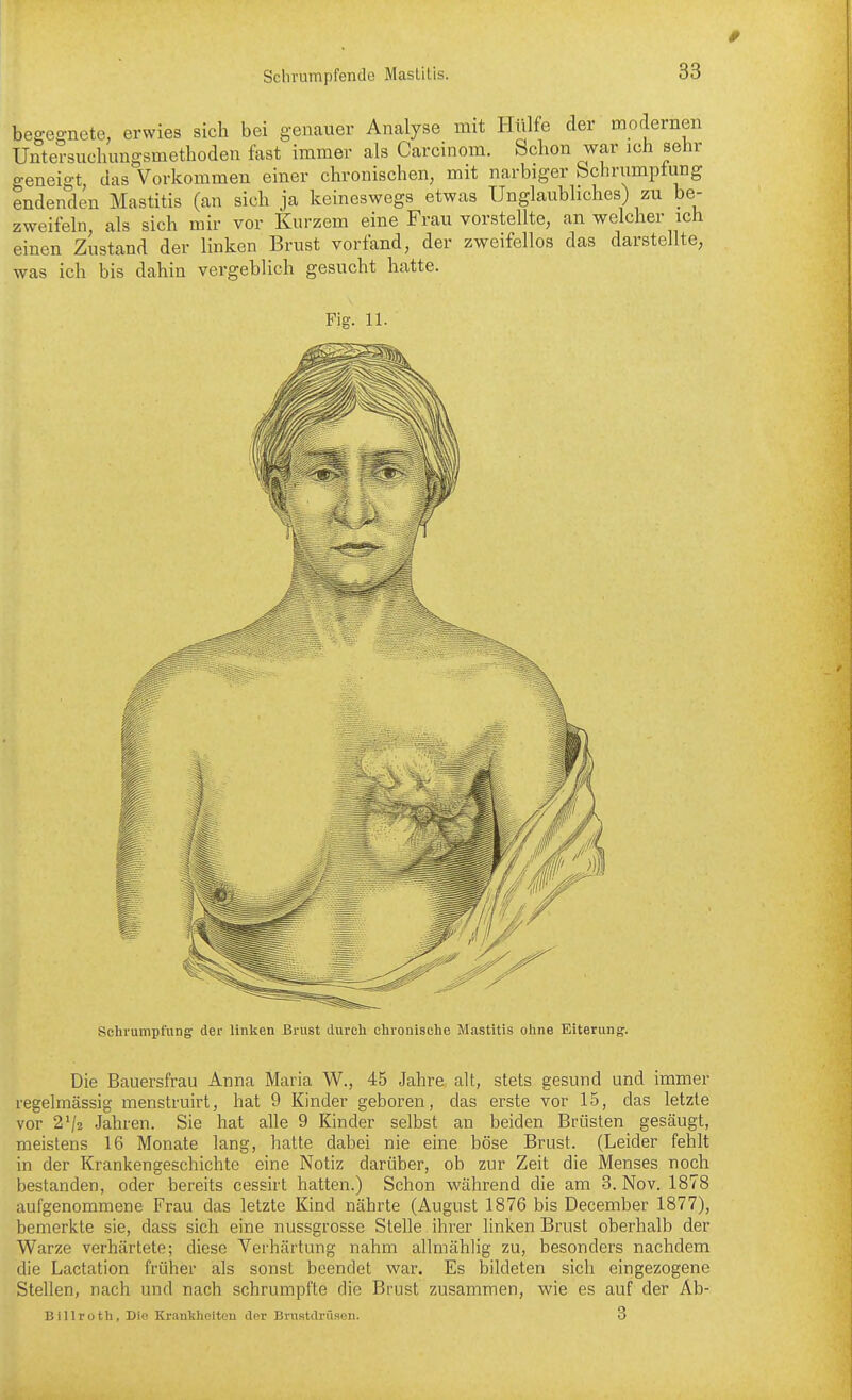 begegnete, erwies sich bei genauer Analyse mit Hülfe der modernen Untersuchungsmethoden fast immer als Carcinom. Schon war ich sehr geneigt, das Vorkommen einer chronischen, mit narbiger Schrumptung endenden Mastitis (an sich ja keineswegs etwas Unglaubliches) zu be- zweifeln als sich mir vor Kurzem eine Frau vorstellte, an welcher ich einen Zustand der linken Brust vorfand, der zweifellos das darstellte, was ich bis dahin vergeblich gesucht hatte. Fio;. 11. Schrumpfung dei' linken Brust durch chronische Mastitis ohne Eiterung. Die Bauersfrau Anna Maria W., 45 Jahre alt, stets gesund und immer regelmässig menstruirt, hat 9 Kinder geboren, das erste vor 15, das letzte vor 2^2 Jahren. Sie hat alle 9 Kinder selbst an beiden Brüsten gesäugt, meistens 16 Monate lang, hatte dabei nie eine böse Brust. (Leider fehlt in der Krankengeschichte eine Notiz darüber, ob zur Zeit die Menses noch bestanden, oder bereits cessirt hatten.) Schon während die am 3. Nov. 1878 aufgenommene Frau das letzte Kind nährte (August 1876 bis December 1877), bemerkte sie, dass sich eine nussgrossc Stelle ihrer linken Brust oberhalb der Warze verhärtete; diese Verhärtung nahm allmählig zu, besonders nachdem die Lactation früher als sonst beendet war. Es bildeten sich eingezogene Stellen, nach und nach schrumpfte die Brust zusammen, wie es auf der Äb- Billruth, Die Krankheiten der Bmatdrü.ien. 3