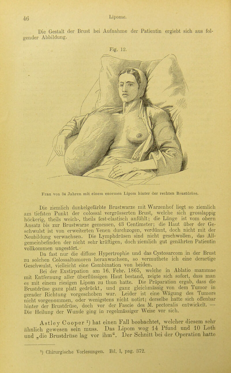 Die Gestalt der Brust bei Aufnahme der Patientin ergiebt sich aus fol- gender Abbildung. Fig. 12. Frau von 34 Jahren mit einem enormen Lipom hinter der rechten Brustdrüse. Die ziemlich dunkelgefärbte Brustwarze mit Warzenhof liegt so ziemhch am tiefsten Punkt der colossal vergrösserten Brust, welche sich grosslappig höckerig, theils weich-, theils fest-elastisch anfühlt; die Länge ist vom obern Ansatz bis zur Brustwarze gemessen, 43 Gentimeter; die Haut über der Ge- schwulst ist von erweiterten Venen durchzogen, verdünnt, doch nicht mit der Neubildung verwachsen. Die Lymphdrüsen sind nicht geschwollen, das All- gemeinbefinden der nicht sehr kräftigen, doch ziemhch gut genährten Patientin vollkommen ungestört. Da fast nur die diffuse Hypertrophie und das Cj'stosarcom in der Brust zu solchen Golossaltumoren heranwachsen, so vermuthete ich eine derartige Geschwulst, vielleicht eine Gombination von beiden. Bei der Exstirpation am 16. Febr. 1865, welche in Ablatio mammae mit Entfernung aller überflüssigen Haut bestand, zeigte sich sofort, dass man es mit einem riesigen Lipom zu thun hatte. Die Präparation ergab, dass die Brustdrüse ganz platt gedrückt, und ganz gleichmässig von dem Tumor in gerader Richtung vorgeschoben war. Leider ist eine Wägung des Tumors nicht vorgenommen, oder wenigstens nicht notirt; derselbe hatte sich offenbar hinter der Brustdrüse, doch vor der Fascie des M. pectoraiis entwickelt. — Die Heilung der Wunde ging in regelmässiger Weise vor sich. Astley Cooper 1) hat einen Fall beobachtet, welcher diesem sehr ähnlich gewesen sein muss. Das Lipom wog 14 Pfund und 10 Loth und „die Brustdrüse lag vor ihm. Der Schnitt bei der Operation hatte ') Chirurgische Vorlesungen. Bd. I, pag. 372.