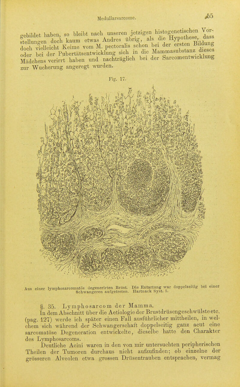 #55 cphiWet haben so bleibt nach unseren jetzigen histogenetischen Vor- Sten doch kaum etwas Andres übrig, als die Hypothese das. doch vielleicht Keime vom M. pectoralis schon bei der ersten Bildung oder bei der Pubertätsentwicklung sich in die Mammasubstanz d eses mdchens verirrt haben und nachträglich bei der Sarcomentwicklung zur Wucherung angeregt wurden. Fis. 17. Aus einer lymphosarcomatös degenerirten Brust. Die Entartung war doppelseitig bei einer Scliwangeren aufgetreten. Hartnack Syst. 5. §. 35. Lymphosarcom der Mamma, In dem Abschnitt über die Aetiologie der Brustdrüsengeschwülste etc. (pag. 127) werde ich später einen Fall ausführlicher mittheilen, in wel- chem sich während der Schwangerschaft doppelseitig ganz acut eine sarcomatöse Degeneration entwickelte, dieselbe hatte den Charakter des Lymphosarcoms. DeutHche Acini waren in den von mir untersuchten peripherischen Theilen der Tumoren durchaus nicht aufzufinden; ob einzelne der grösseren Alveolen etwa grossen Drüsentrauben entsprachen, vermag