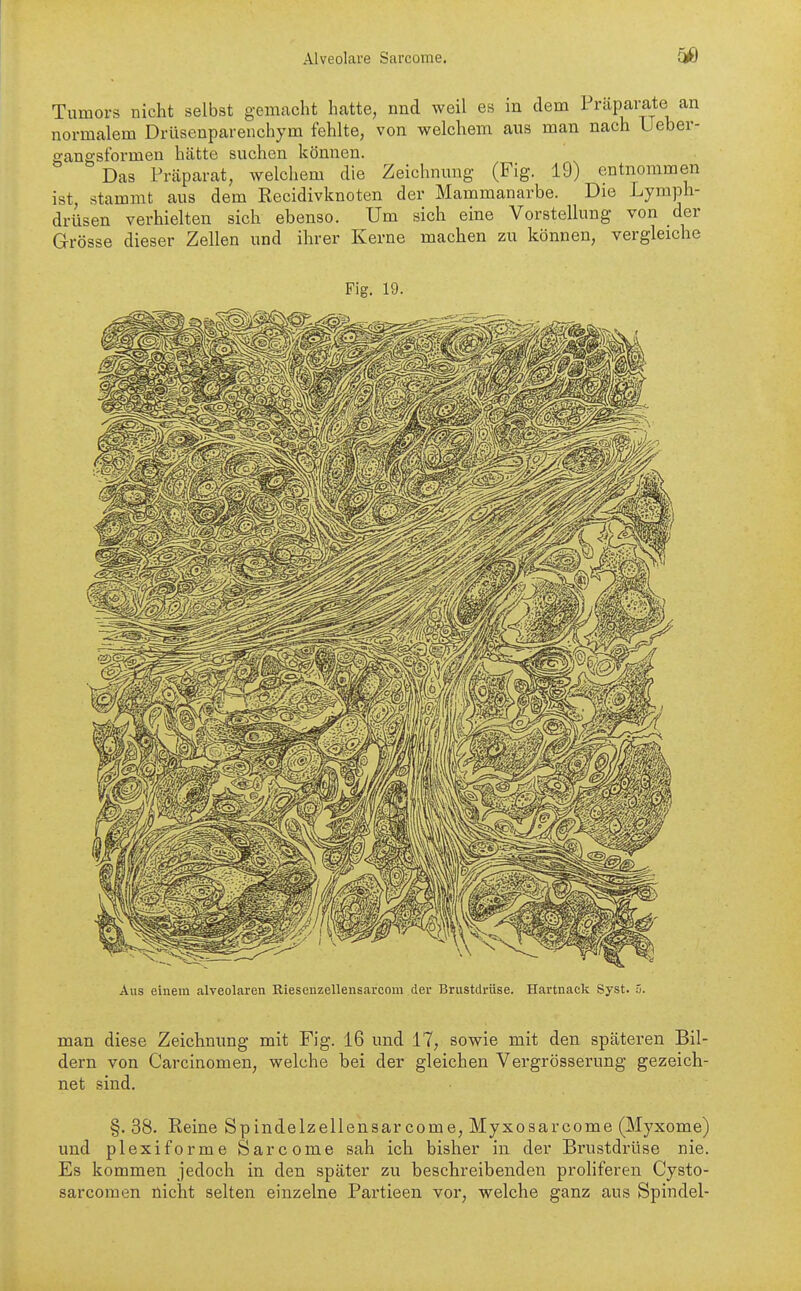 Tumors nicht selbst gemacht hcatte, nnd weil es in dem Präparate an normalem Drüsenparenehym fehlte, von welchem aus man nach Ueber- ganffsformen hätte suchen können. Das Präparat, welchem die Zeichnung (Fig. 19) entnommen ist, stammt aus dem Recidivknoten der Mammanarbe. Die Lymph- drüsen verhielten sich ebenso. Um sich eine Vorstellung von der Grösse dieser Zellen und ihrer Kerne machen zu können, vergleiche Fig. 19. Aus einem alveolaren Riesenzellensarcom der Brustdrüse. Hartnack Syst. ä. man diese Zeichnung mit Fig. 16 und 17, sowie mit den späteren Bil- dern von Carcinomen, welche bei der gleichen Vei'grösserung gezeich- net sind. §. 38. Reine Spindelzellensar com e, Myxo sarcome (Myxome) und plexiforme Sarcome sah ich bisher in der Brustdrüse nie. Es kommen jedoch in den später zu beschreibenden proHferen Cysto- sarcomen uicht selten einzelne Partieen vor, welche ganz aus Spindel-