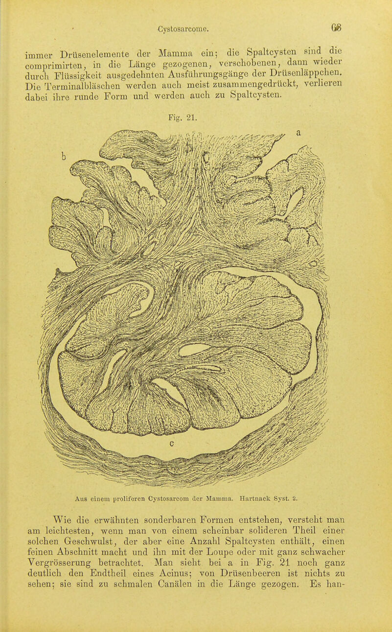 immer Drüseuelemente der Mamma ein; die Spaltcysten Rind die comprimirten, in die Länge gezogenen, verschobenen, dann wieder durch Flüssigkeit ausgedehnten Ausführungsgänge der Drüsenläppchen. Die Terminalbläschen werden auch meist zusammengedrückt, verlieren dabei ihre runde Form und werden auch zu Spaltcysten. Fig. 21. Aus einem proliferen Cystosarcom der Mamma. Hartnack Syst. 2. Wie die erwähnten sonderbaren Formen entstehen, versteht man am leichtesten, wenn man von einem scheinbar solideren Theil einer solchen Geschwulst, der aber eine Anzahl Spaltcysten enthält, einen feinen Abschnitt macht und ihn mit der Loupe oder mit ganz schwacher Vergrösserung betrachtet. Man sieht bei a in Fig. 21 noch ganz deutlich den Endtheil eines Acinus; von Drüsenbeeren ist nichts zu sehen; sie sind zu schmalen Canälen in die Länge gezogen. Es han-